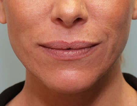 Patient after Mentor Peel procedure performed at Mentor Plastic Surgery and MedSpa