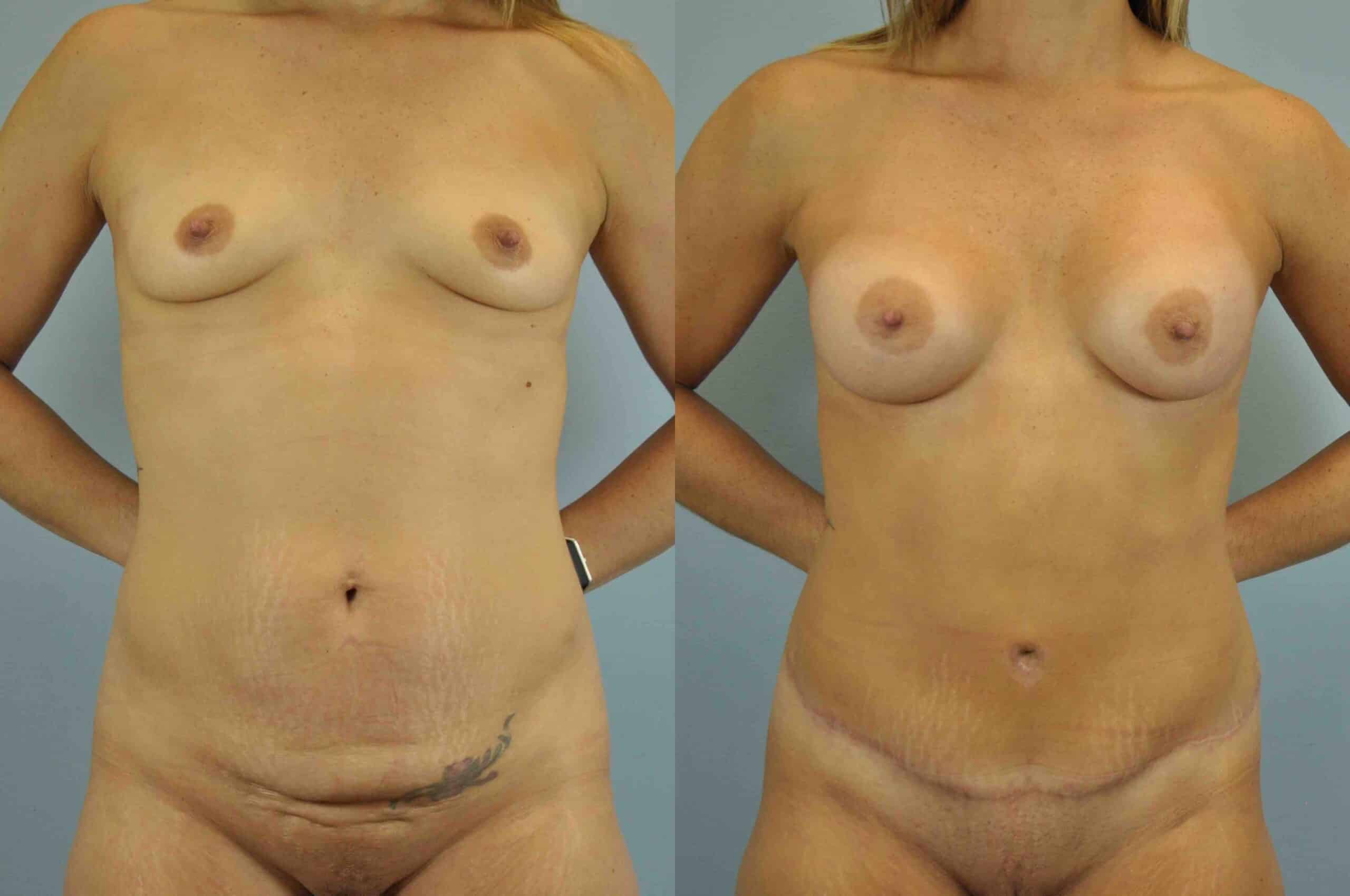 Before and after, patient 2 mo post op from Tummy Tuck and Breast Augmentation procedures performed by Dr. Paul Vanek