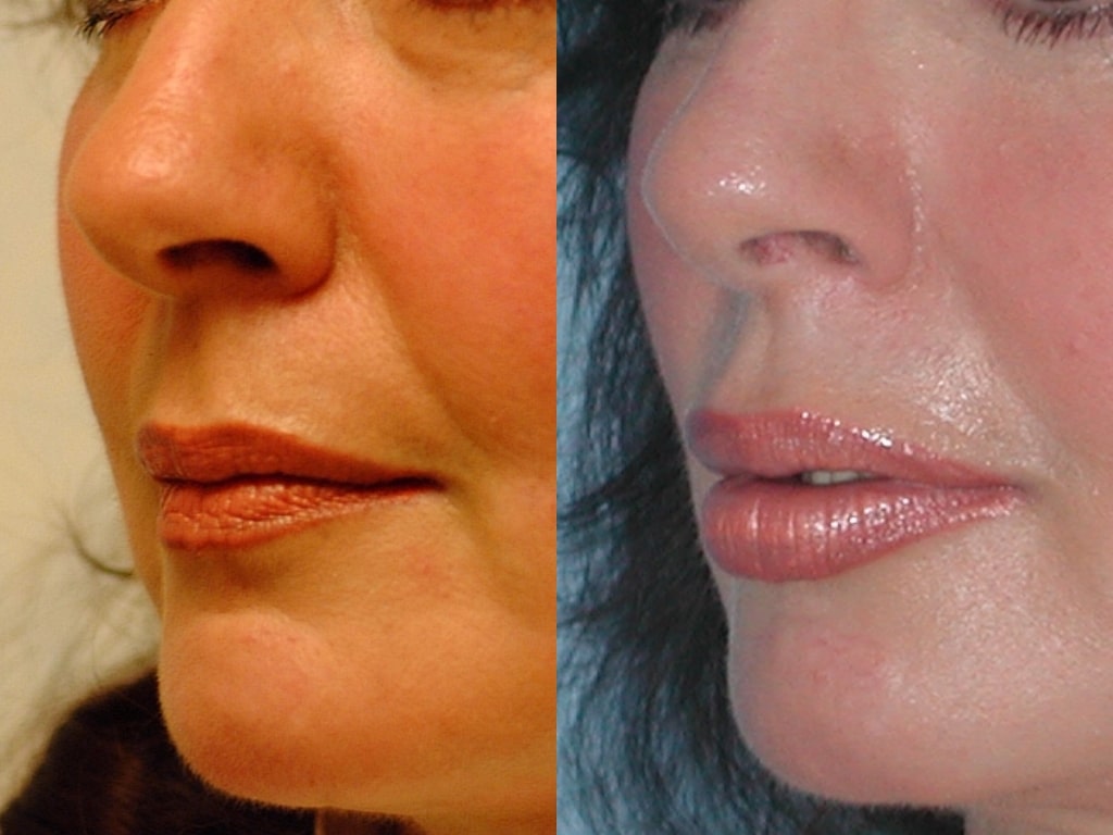 Before and after, patient 1 mo post op from Lip Augmentation with Fat Transfer procedure performed by Dr. Paul Vanek
