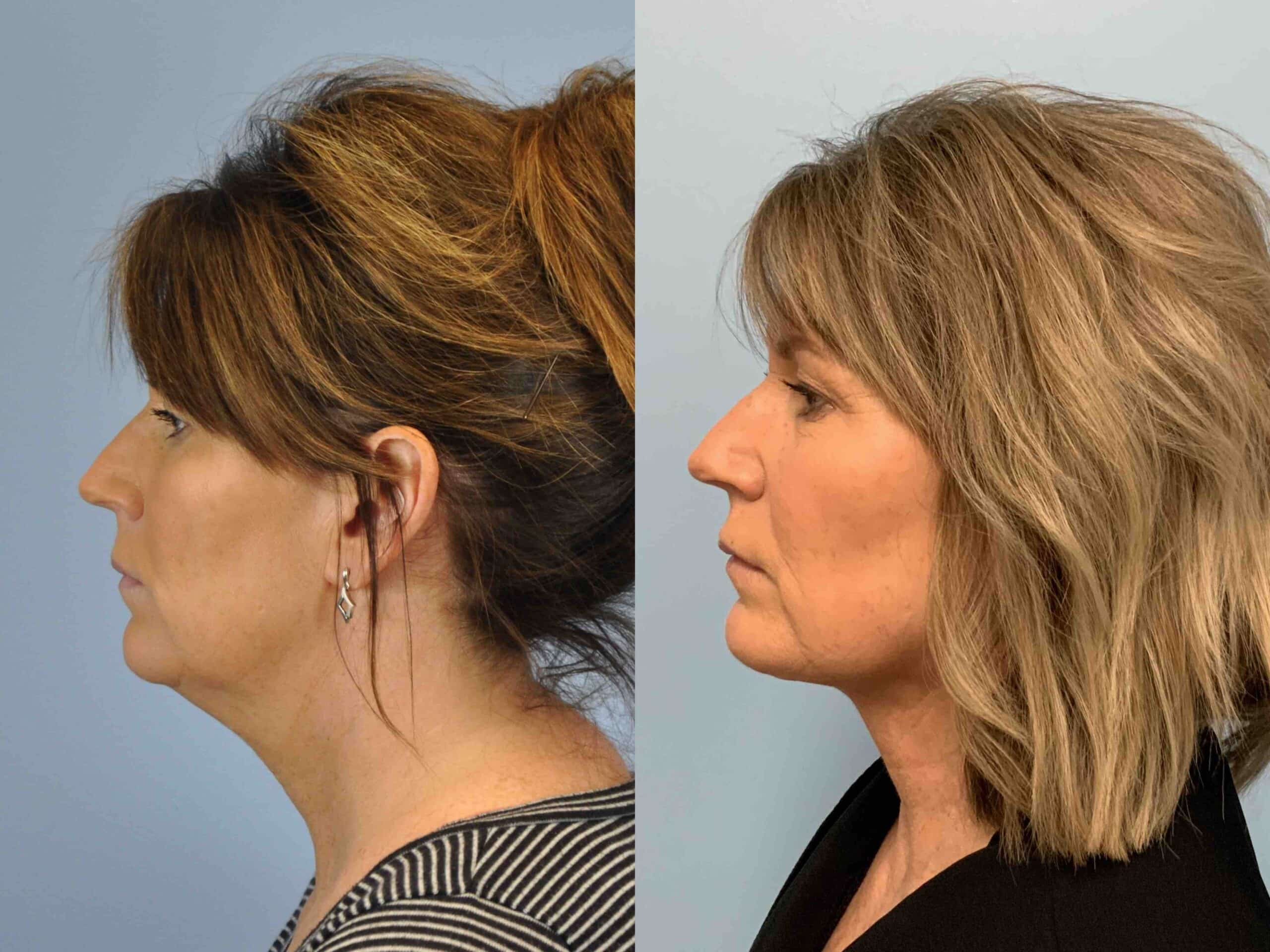Before and after, patient 3 yr post op from Neck Lift, Renuvion Neck procedures performed by Dr. Paul Vanek