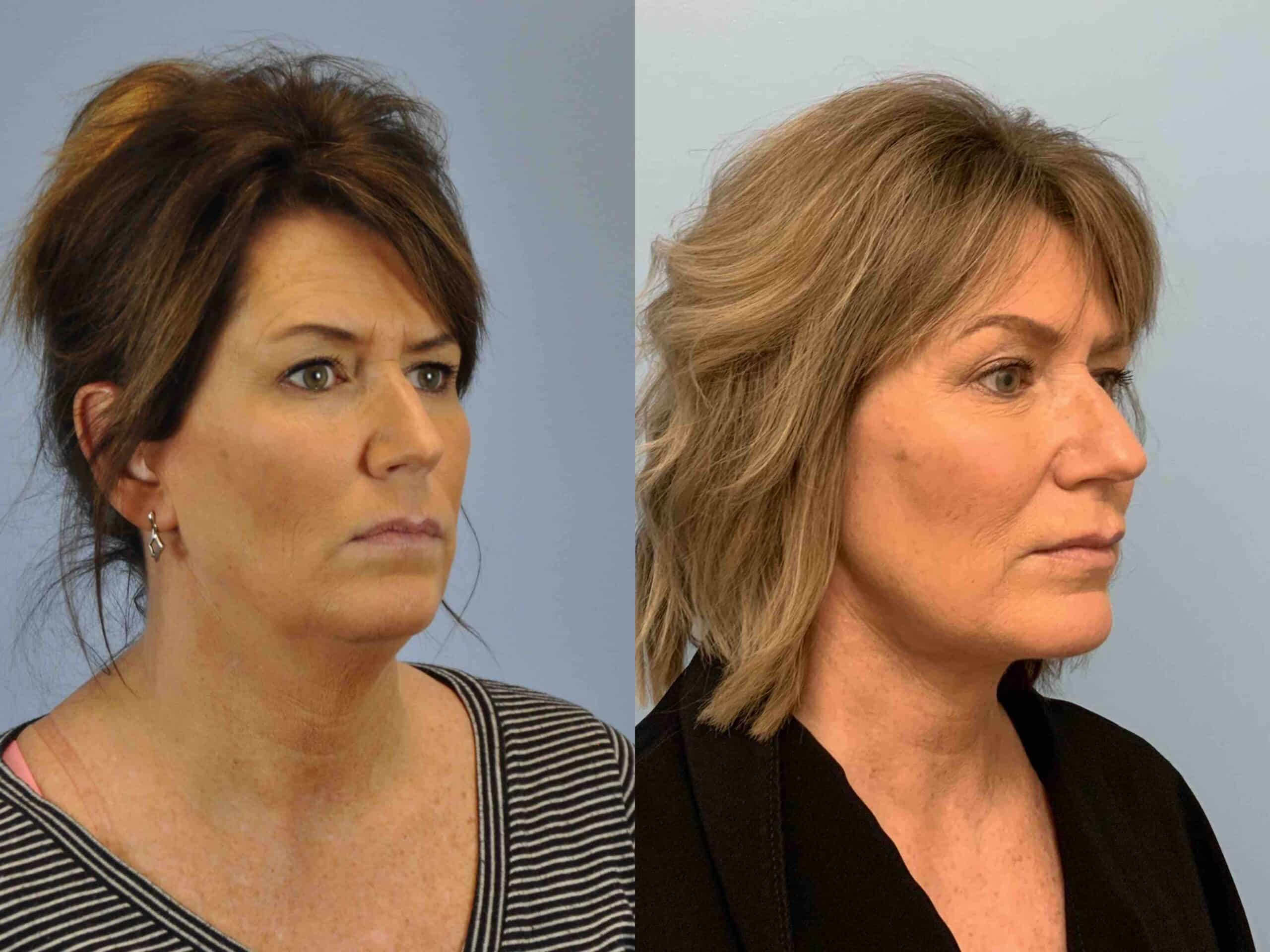 Before and after, patient 3 yr post op from Neck Lift, Renuvion Neck procedures performed by Dr. Paul Vanek