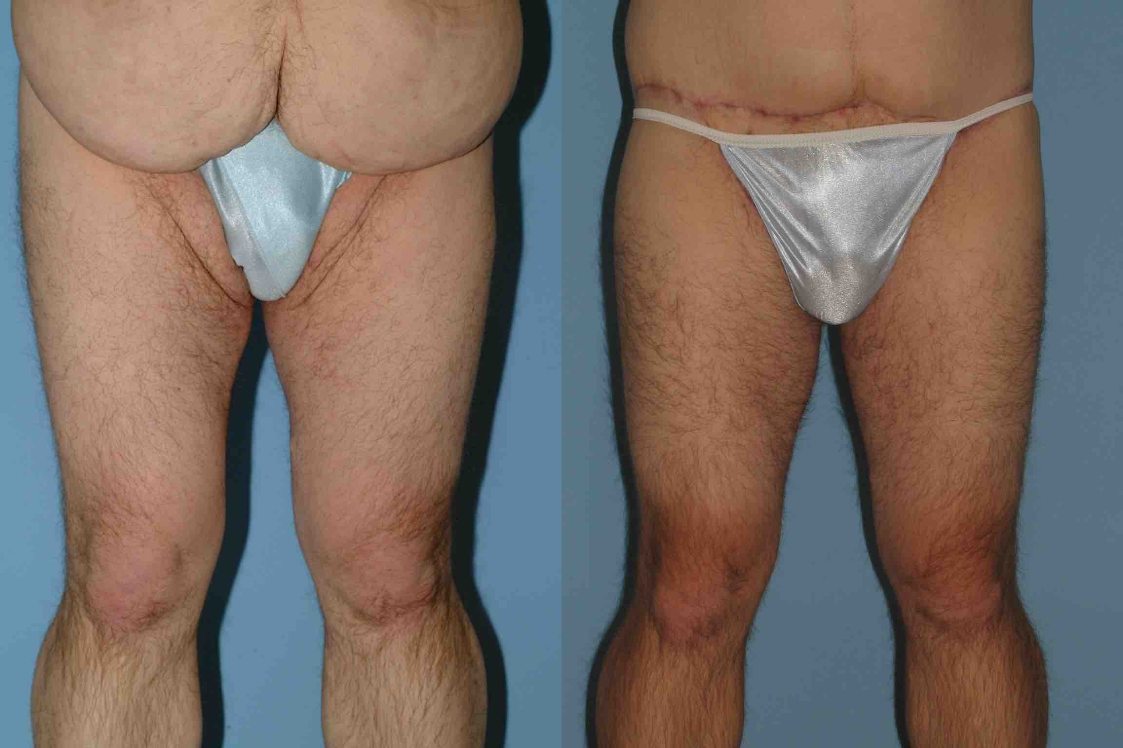 Before and after, patient 3 mo post op from VASER Abdomen, Tummy Tuck, Thighplasty procedures performed by Dr. Paul Vanek