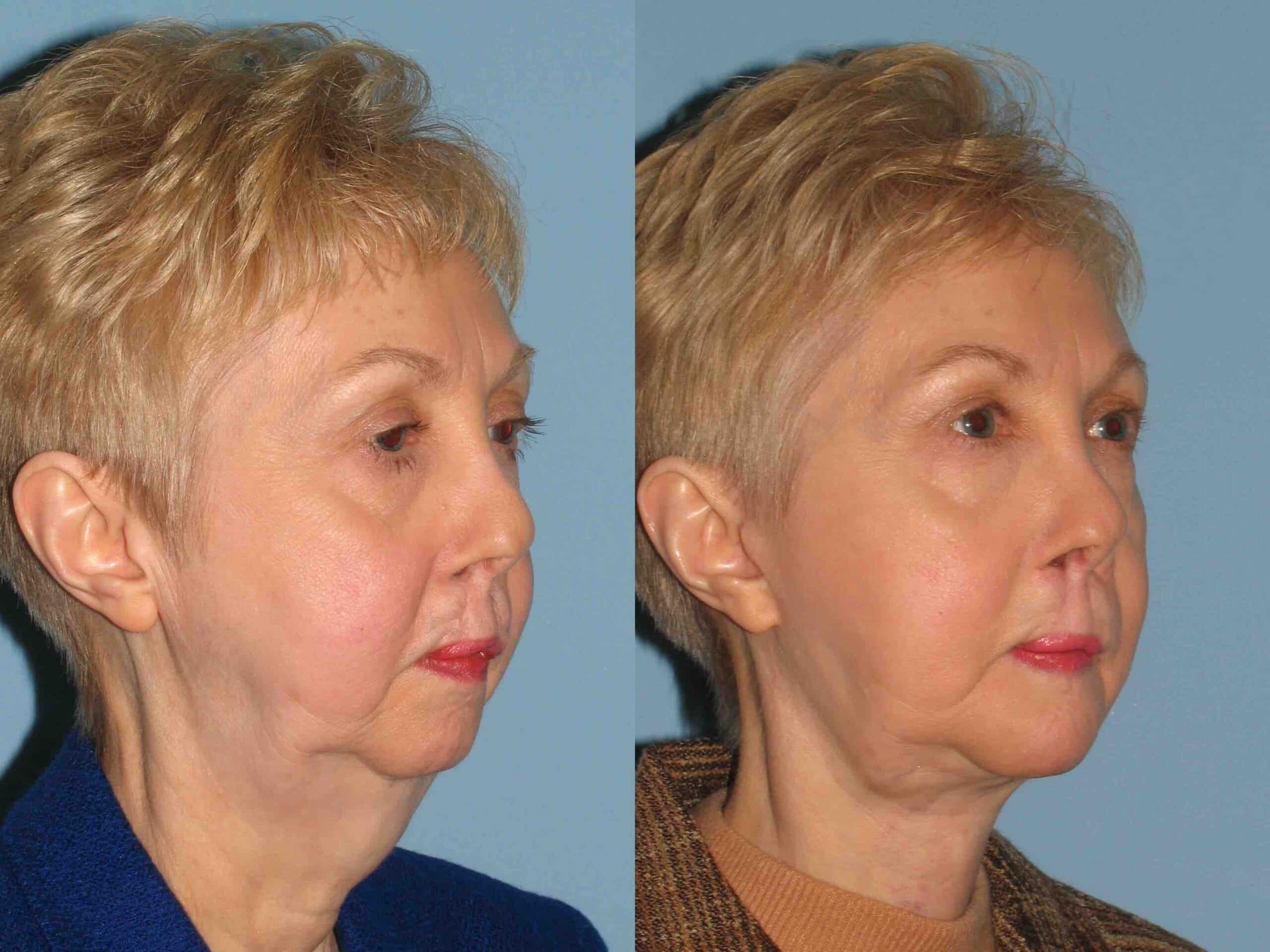 Before and after, patient 1 yr post op after Neck Lift, Facelift, VASER neck, Scar Revision Nose & Cleft Lip, Chin Augmentation w/Implant – Genioplasty procedures performed by Dr. Paul Vanek