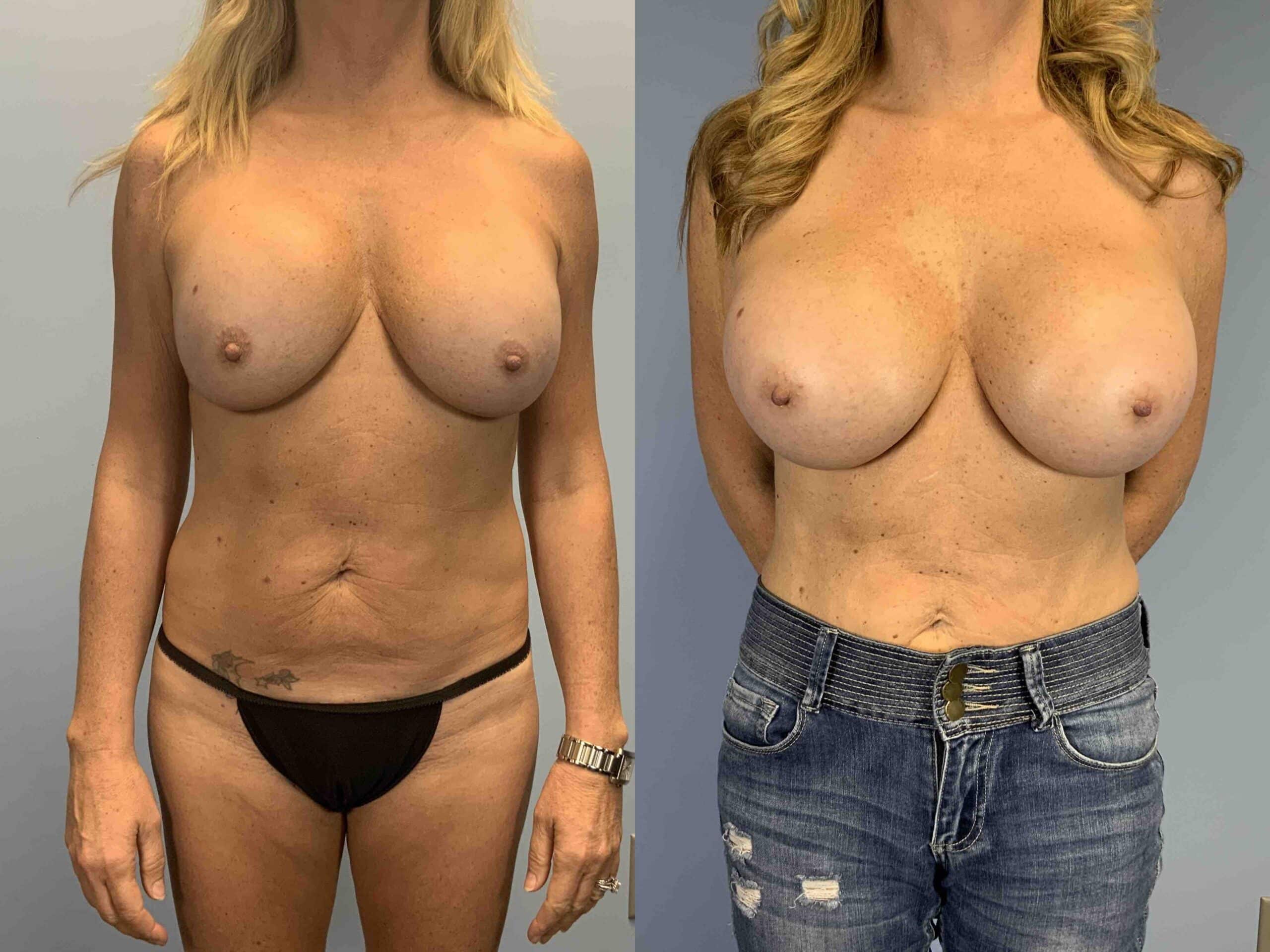 Before and after, patient 2 mo post op from Explant Breast Implant 325 cc, Capsulectomy, Breast Re-Augmentation, Strattice Reinforcement, Level III Muscle Release procedures performed by Dr. Paul Vanek