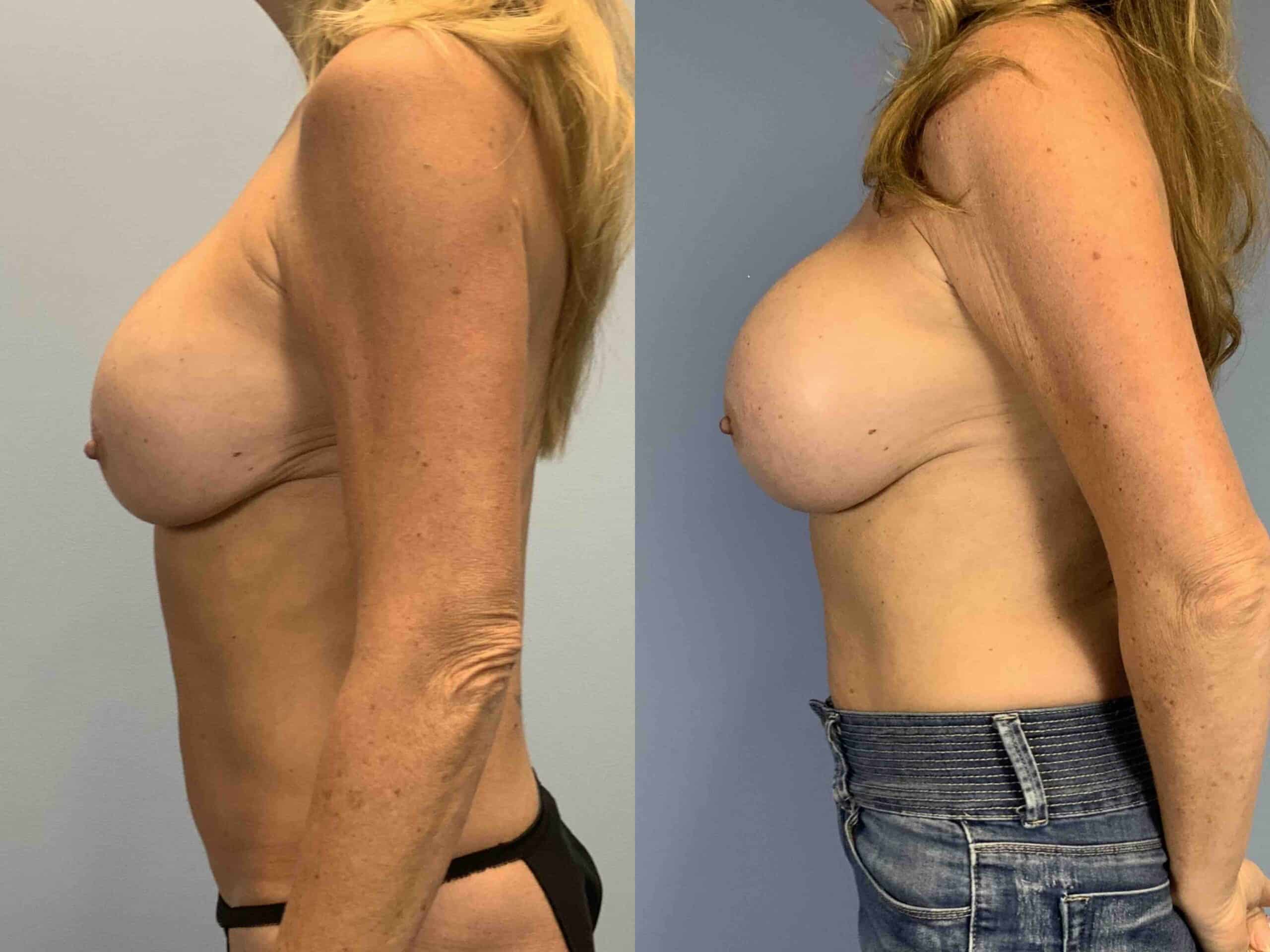 Before and after, patient 2 mo post op from Explant Breast Implant 325 cc, Capsulectomy, Breast Re-Augmentation, Strattice Reinforcement, Level III Muscle Release procedures performed by Dr. Paul Vanek