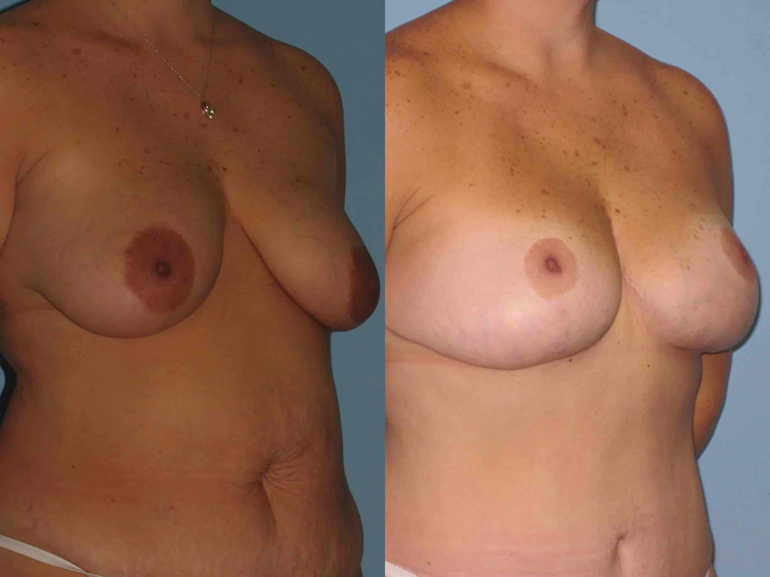 Before and after, patient 2 yr 7 mo post op from VASER Flanks Axilla Back, Breast Lift/Mastopexy, Tummy Tuck procedures performed by Dr. Paul Vanek