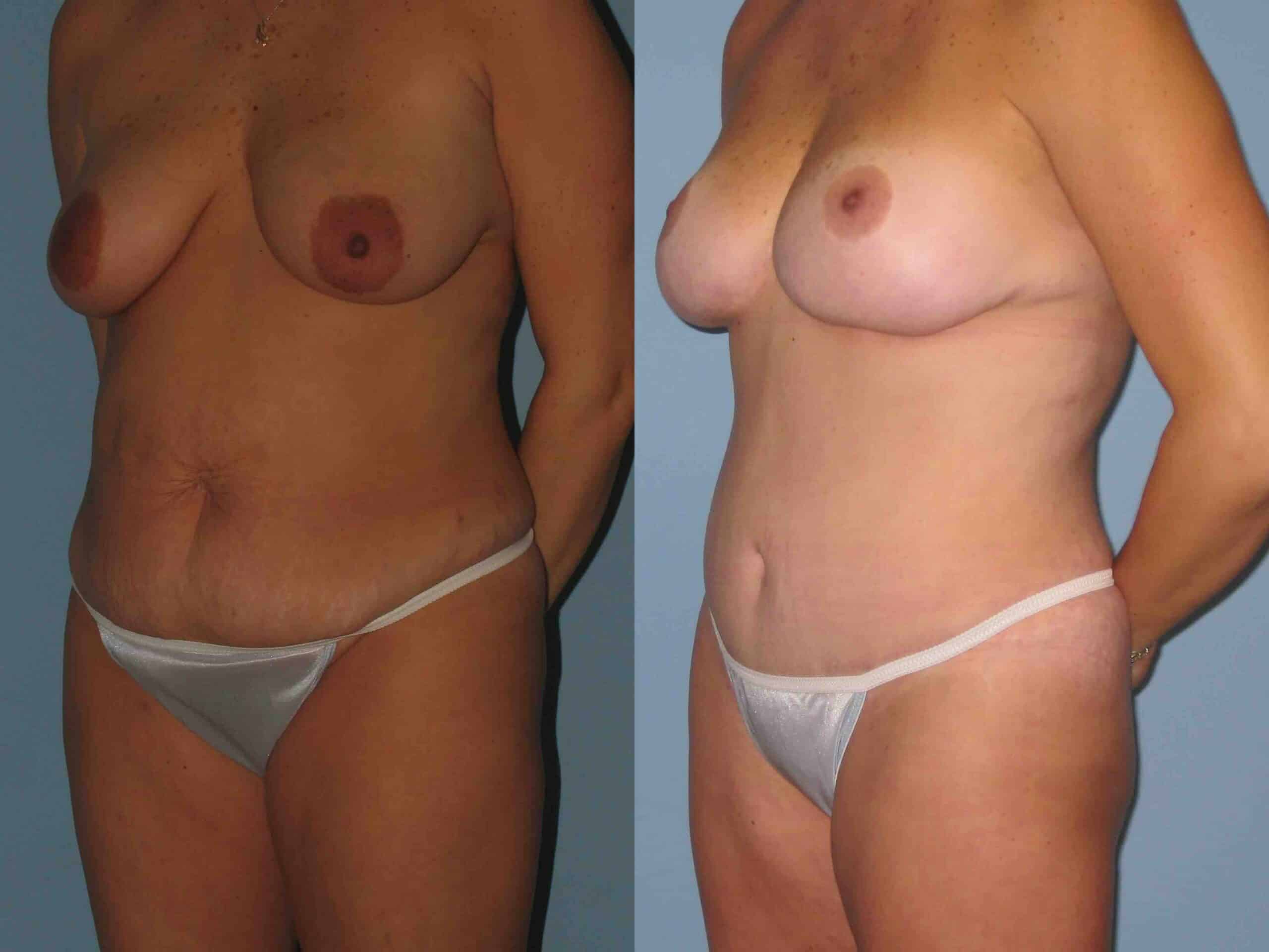 Before and after, patient 2 yr 7 mo post op from VASER Flanks Axilla Back, Breast Lift/Mastopexy, Tummy Tuck procedures performed by Dr. Paul Vanek