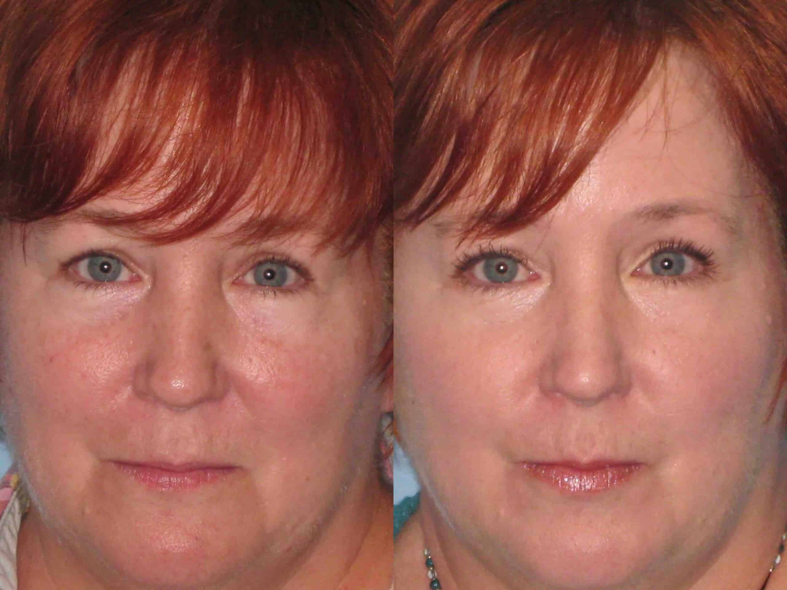 Before and after, 3 mo post-treatment from Laser Resurfacing performed by Dr. Paul Vanek