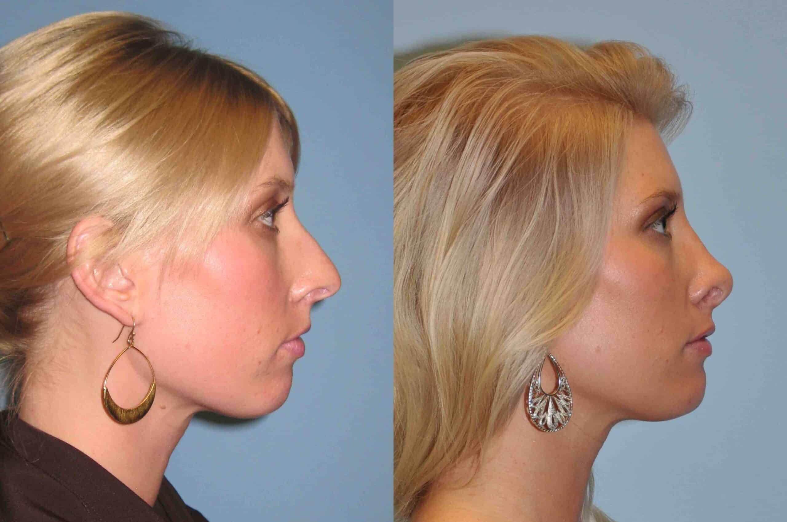 Before and after, 2 yr post op from Rhinoplasty performed by Dr. Paul Vanek