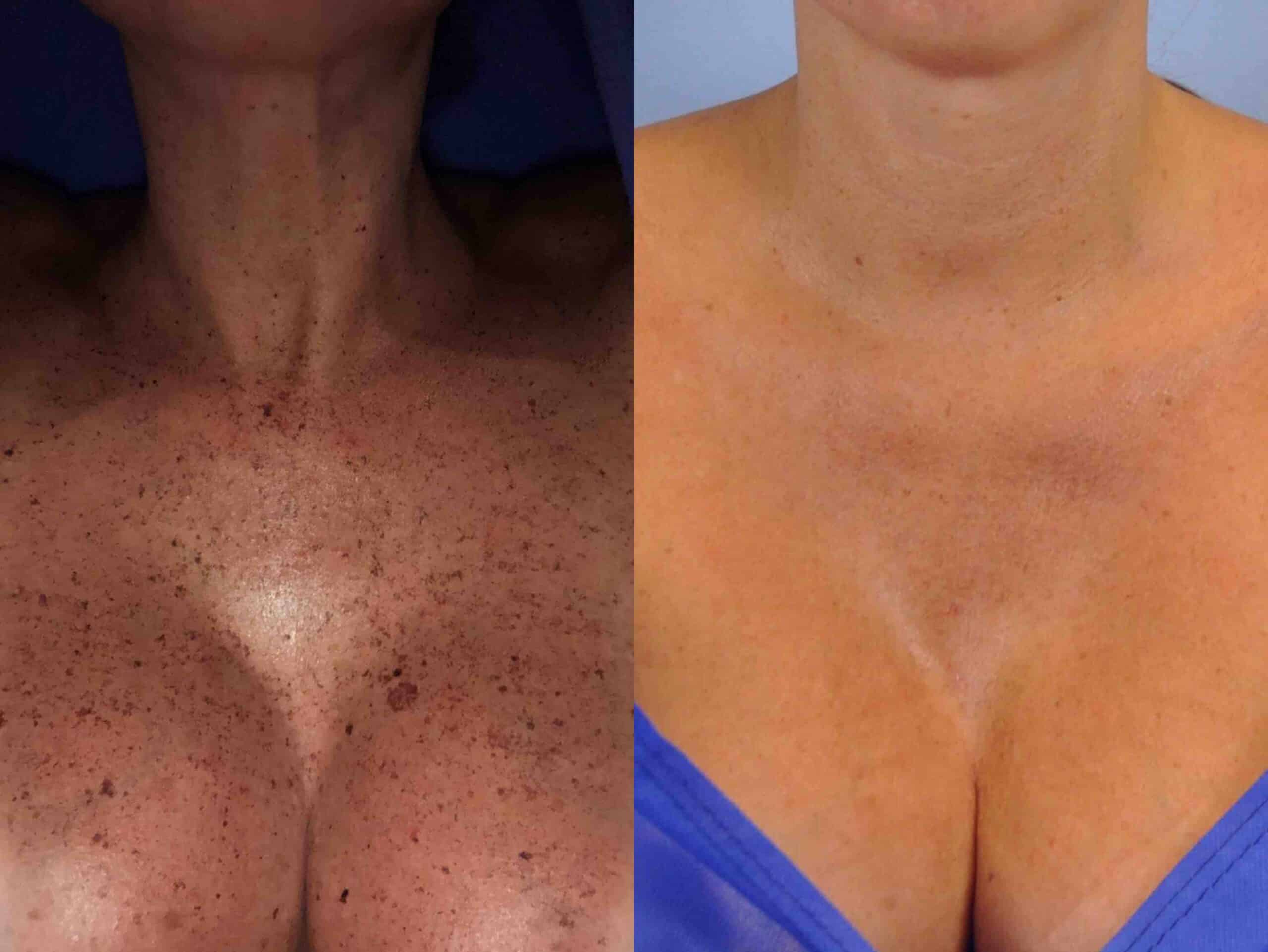 Before and after, 6 w post-treatment from Forever Young Laser BBL performed by Dr. Paul Vanek (close up, front view of chest)
