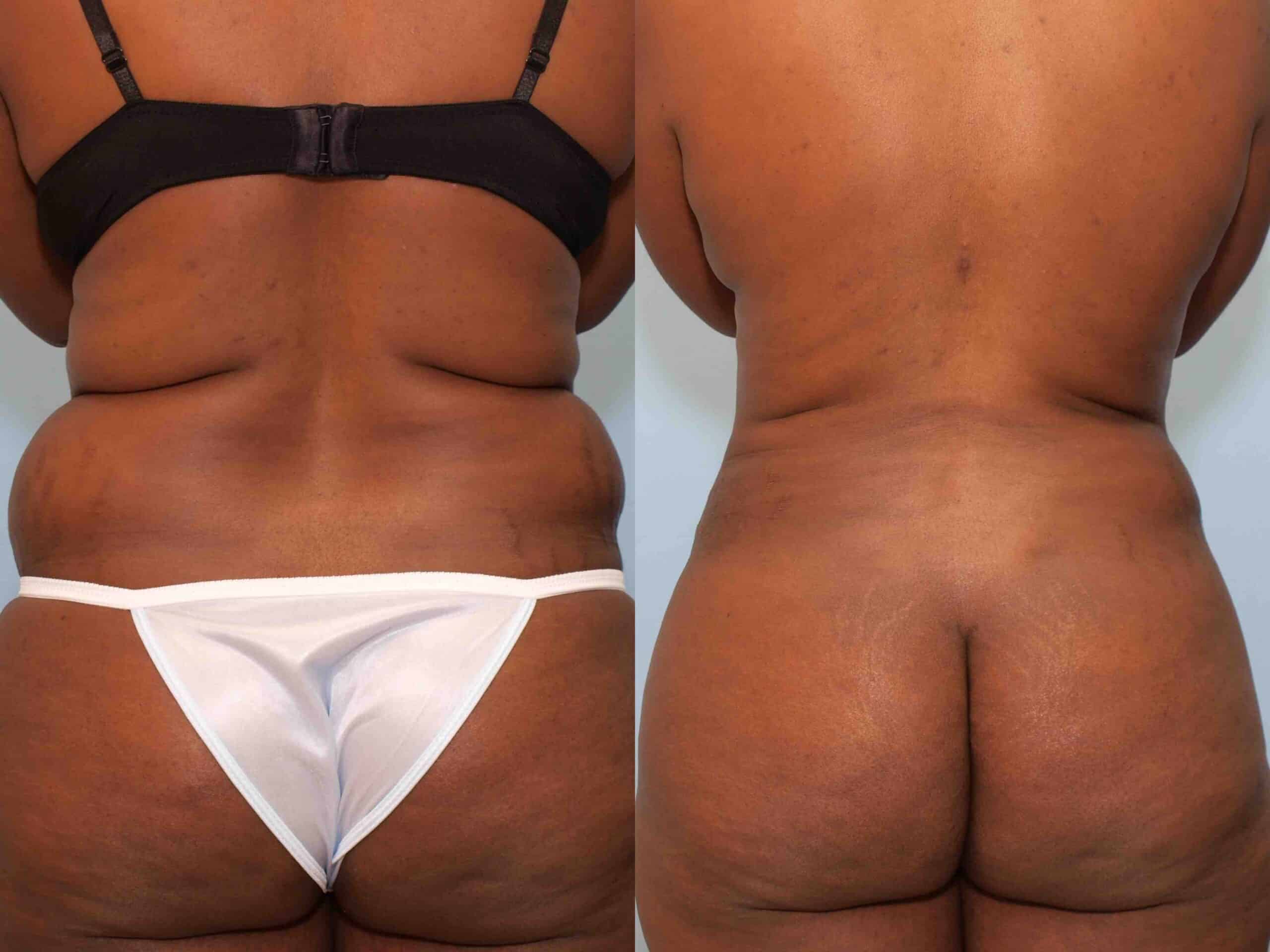 Before and after, patient 2 mo post op from VASER Abdomen, Back, and Flanks procedures performed by Dr. Paul Vanek