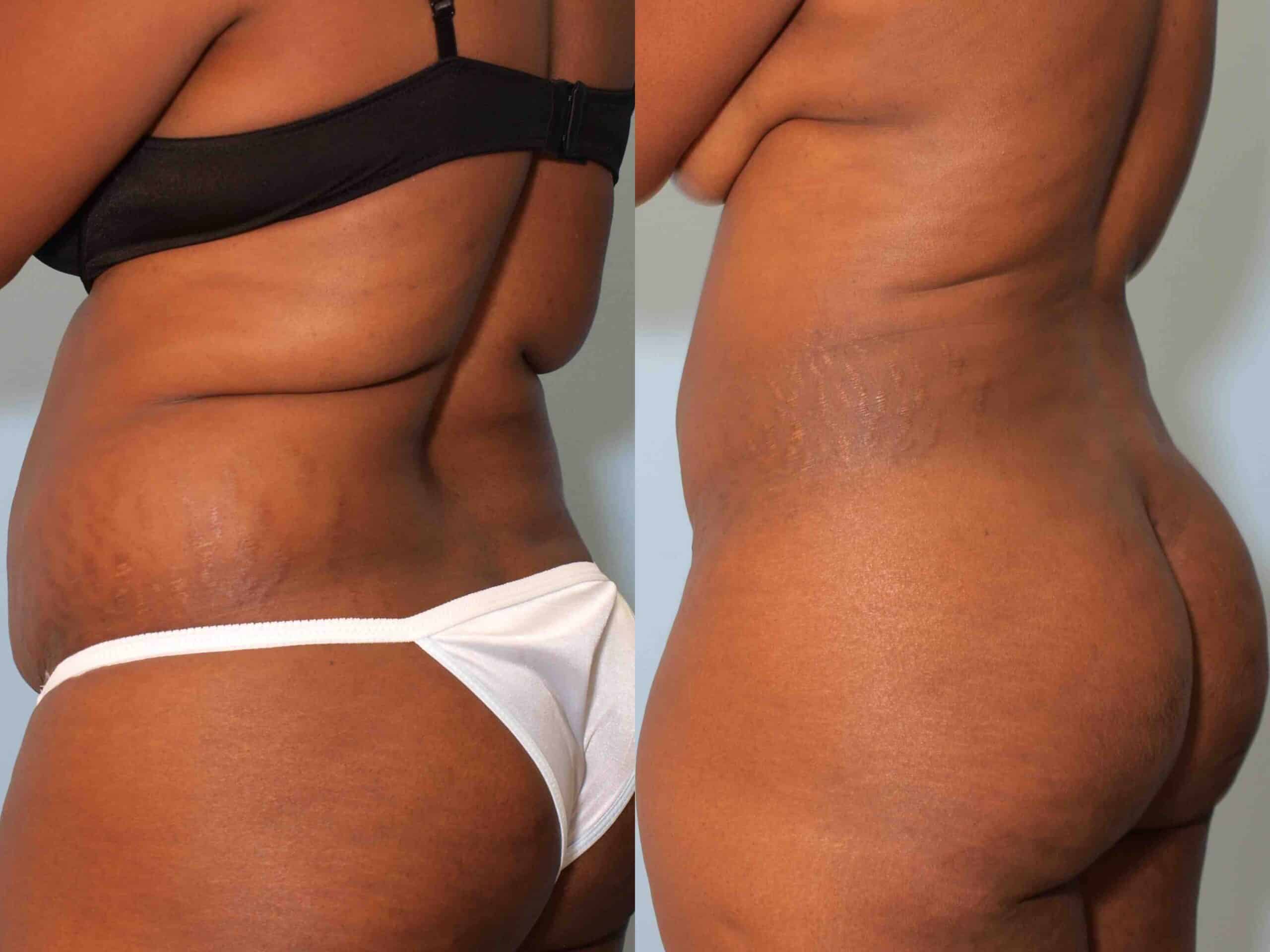 Before and after, patient 2 mo post op from VASER Abdomen, Back, and Flanks procedures performed by Dr. Paul Vanek