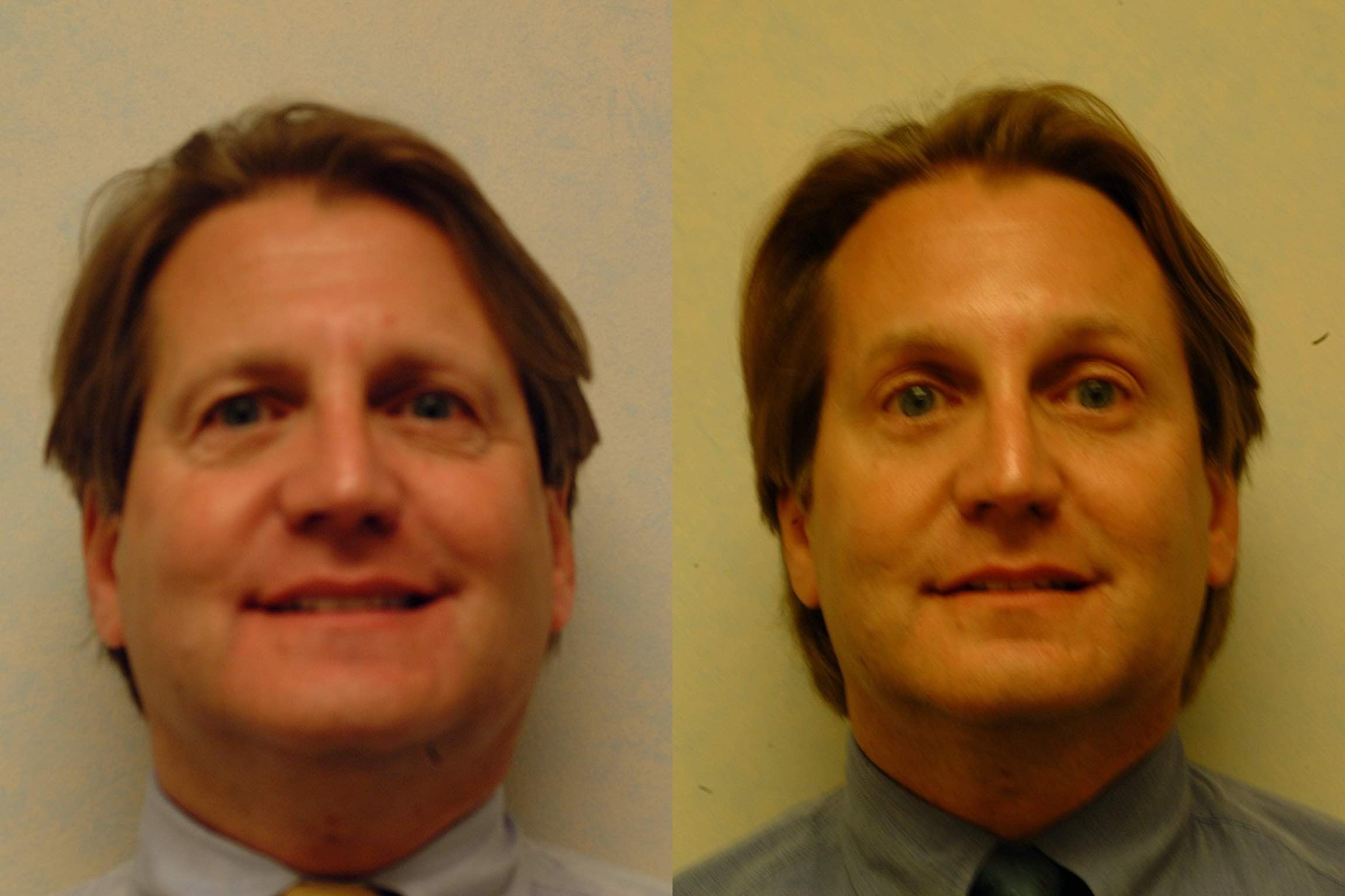 Before and after, 5 mo post op from Endo Brow Lift and Upper and Lower Blepharoplasty performed by Dr. Paul Vanek (front view)