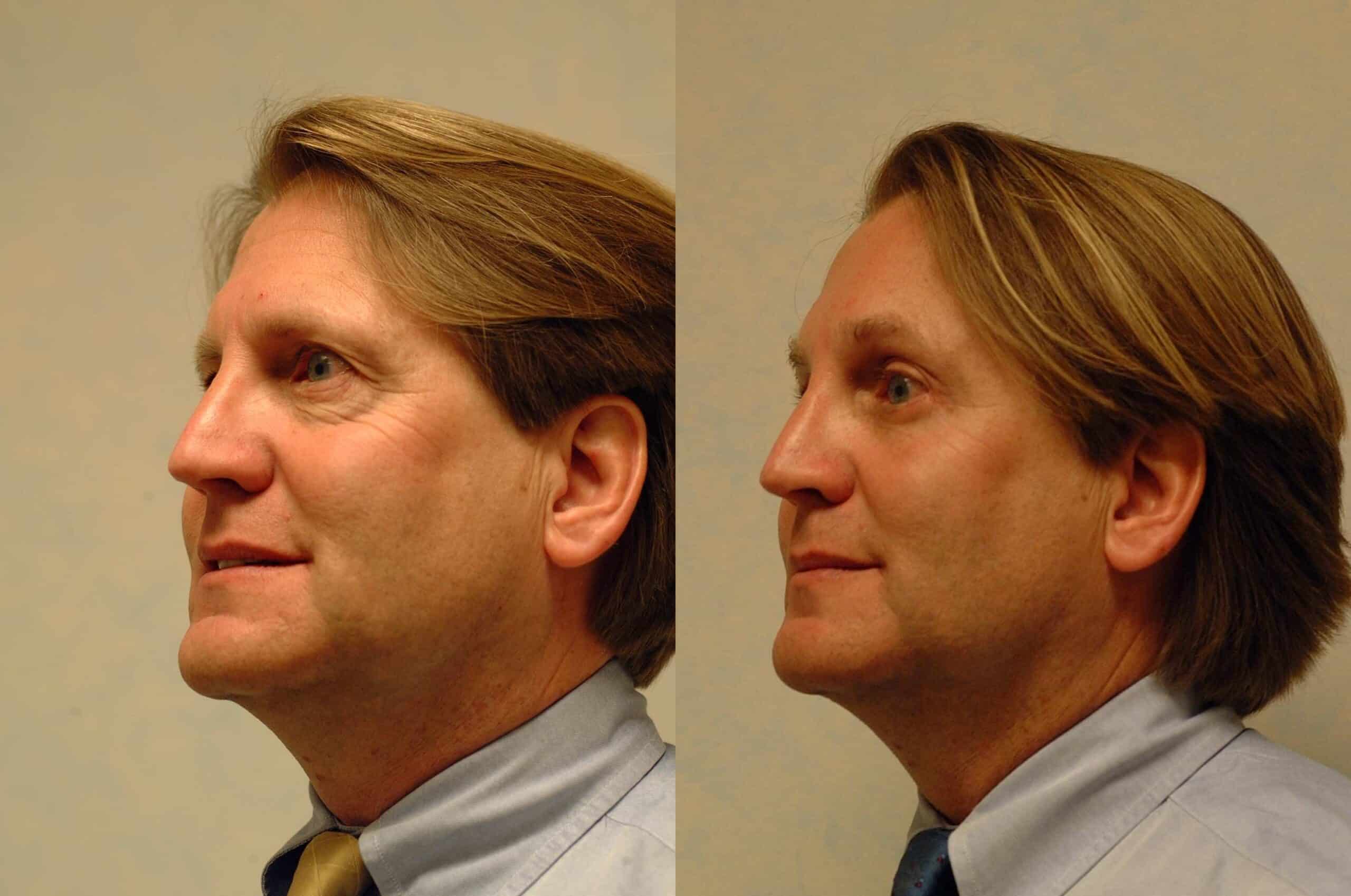 Before and after, 5 mo post op from Endo Brow Lift and Upper and Lower Blepharoplasty performed by Dr. Paul Vanek (diagonal view)