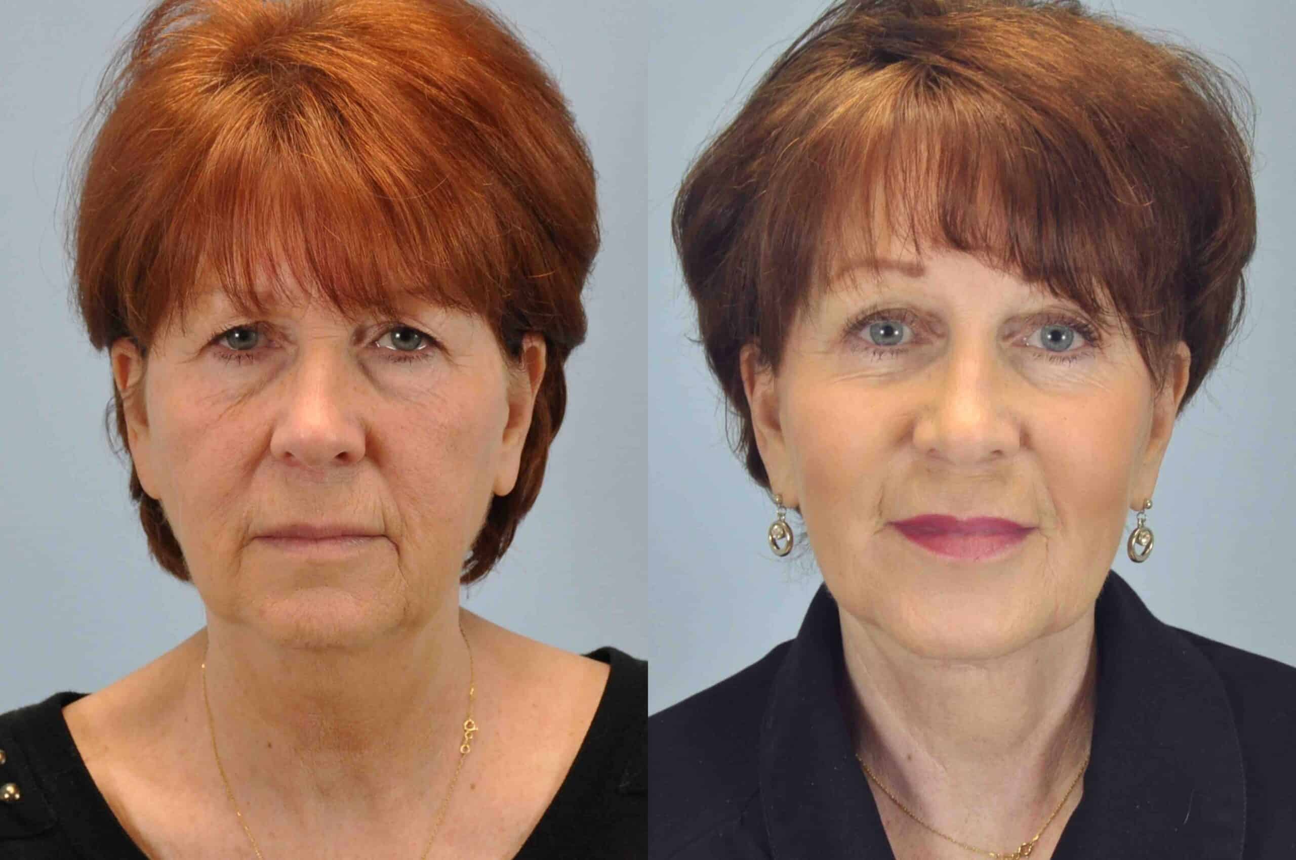 Before and after, patient 1 yr post op from Autologous Fat Transfer Face, Lip Augmentation, Facelift, Necklift, Endo Brow, Lower Blepharoplasty/ Canthopexy procedures performed by Dr. Paul Vanek