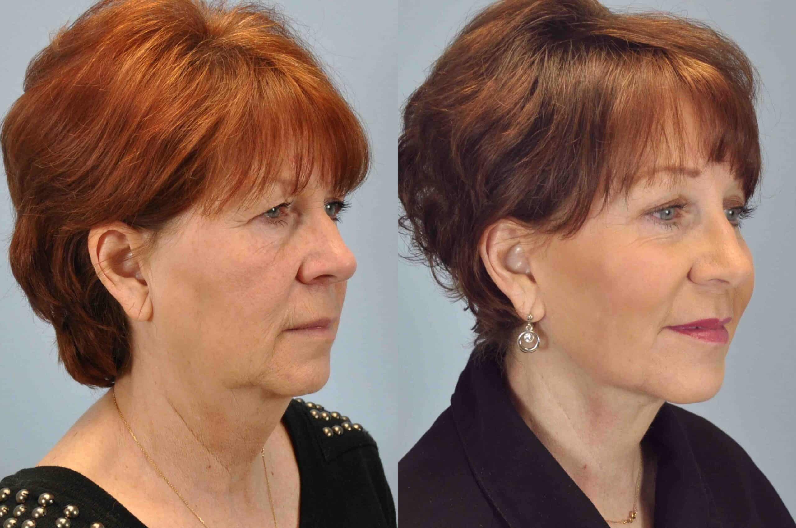 Before and after, patient 1 yr post op from Autologous Fat Transfer Face, Lip Augmentation, Facelift, Necklift, Endo Brow, Lower Blepharoplasty/ Canthopexy procedures performed by Dr. Paul Vanek