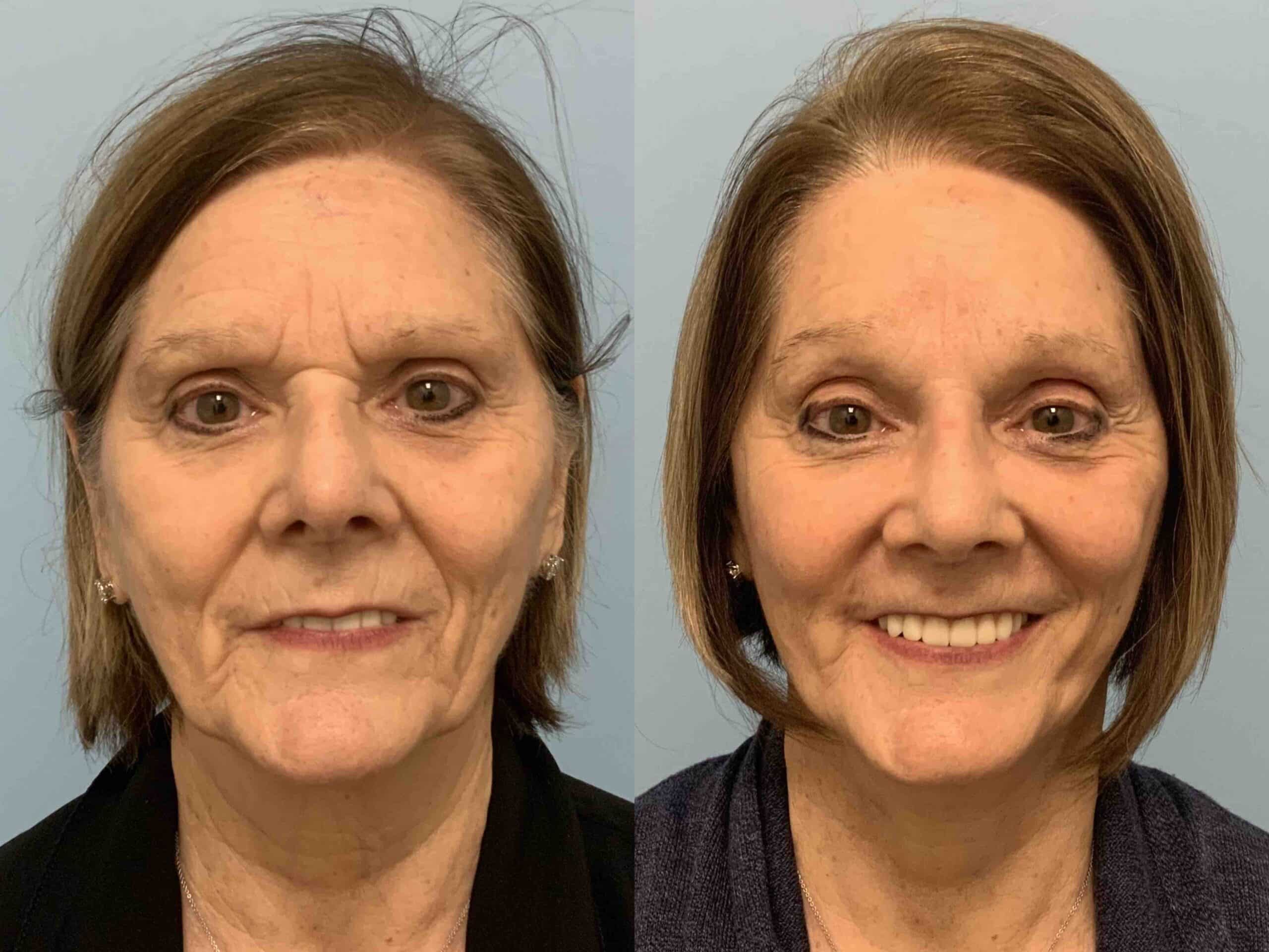 Before and after, patient 8 mo post op from Facelift, Neck Lift, Autologous Fat Transfer to Face procedures performed by Dr. Paul Vanek