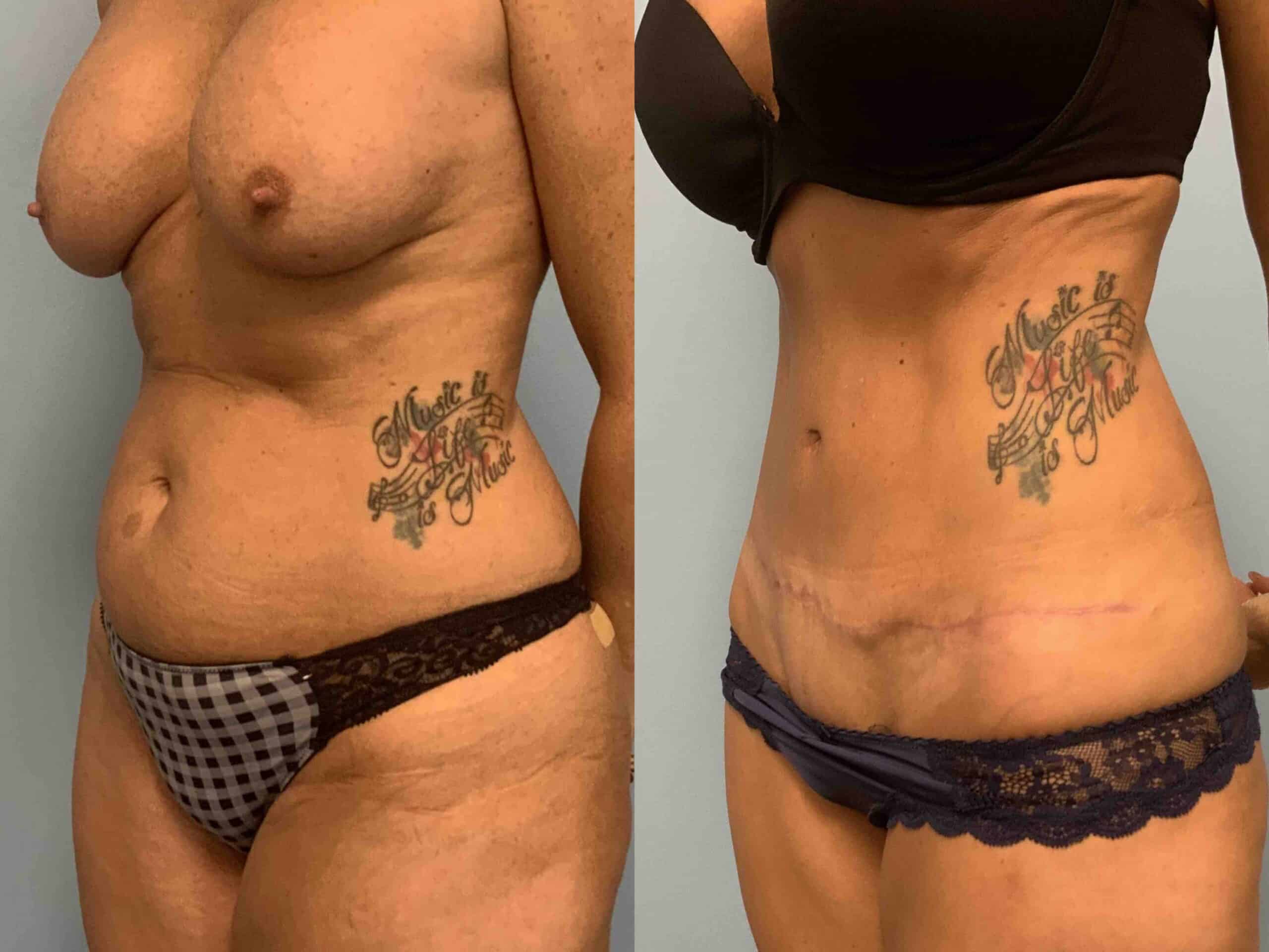 Before and after, patient 3 mo post op from Renuvion Abdomen, Tummy Tuck VASER procedures performed by Dr. Paul Vanek