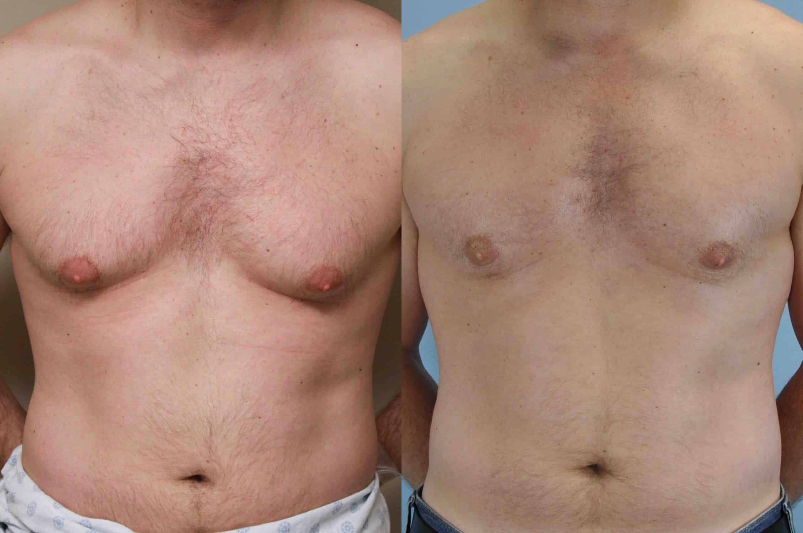 Before and after, patient 3 mo post op from Gynecomastia and VASER chest procedures performed by Dr. Paul Vanek