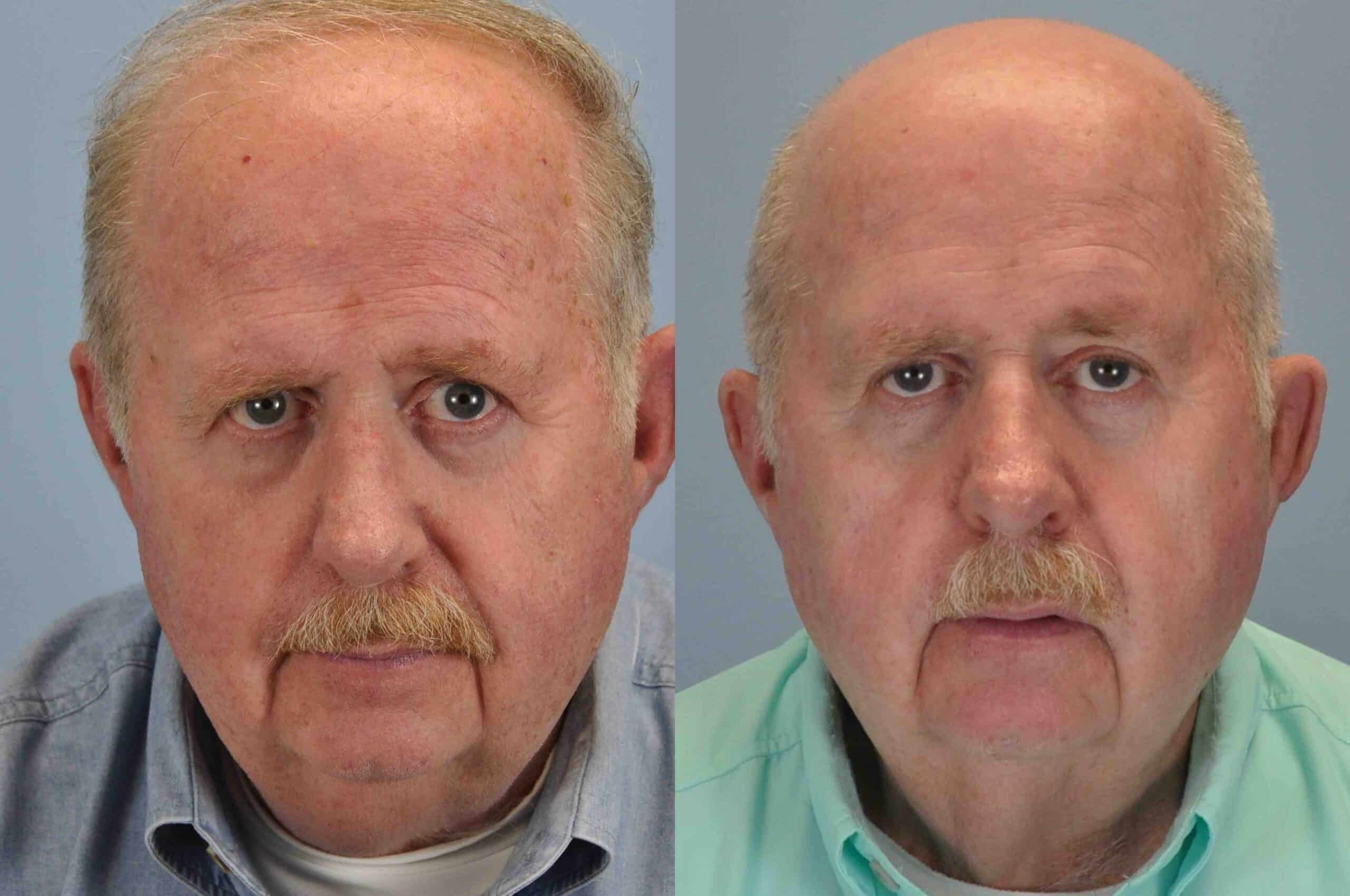 Before and after, 7 mo post-treatment from Laser Resurfacing, Mentor Peel performed by Dr. Paul Vanek (front view)