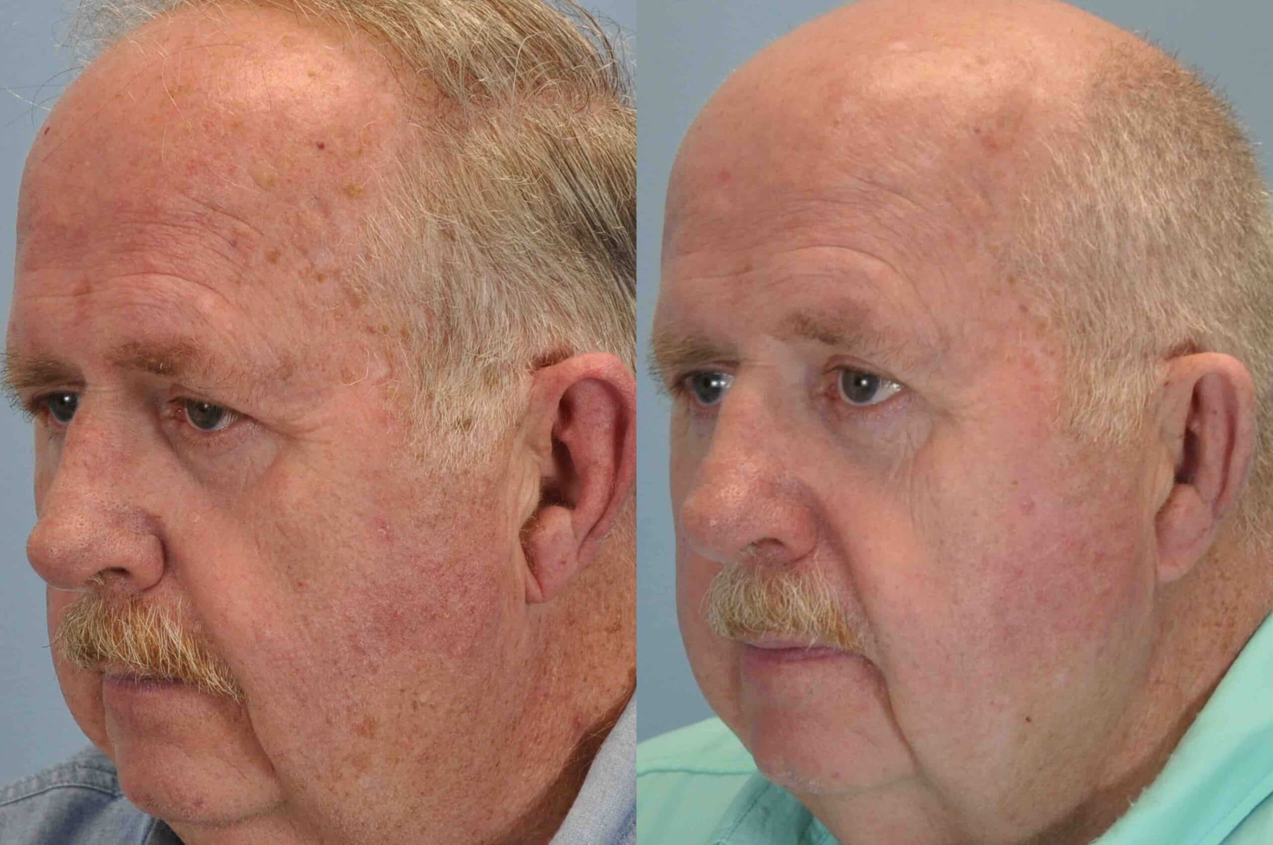 Before and after, 7 mo post-treatment from Laser Resurfacing, Mentor Peel performed by Dr. Paul Vanek (diagonal view)