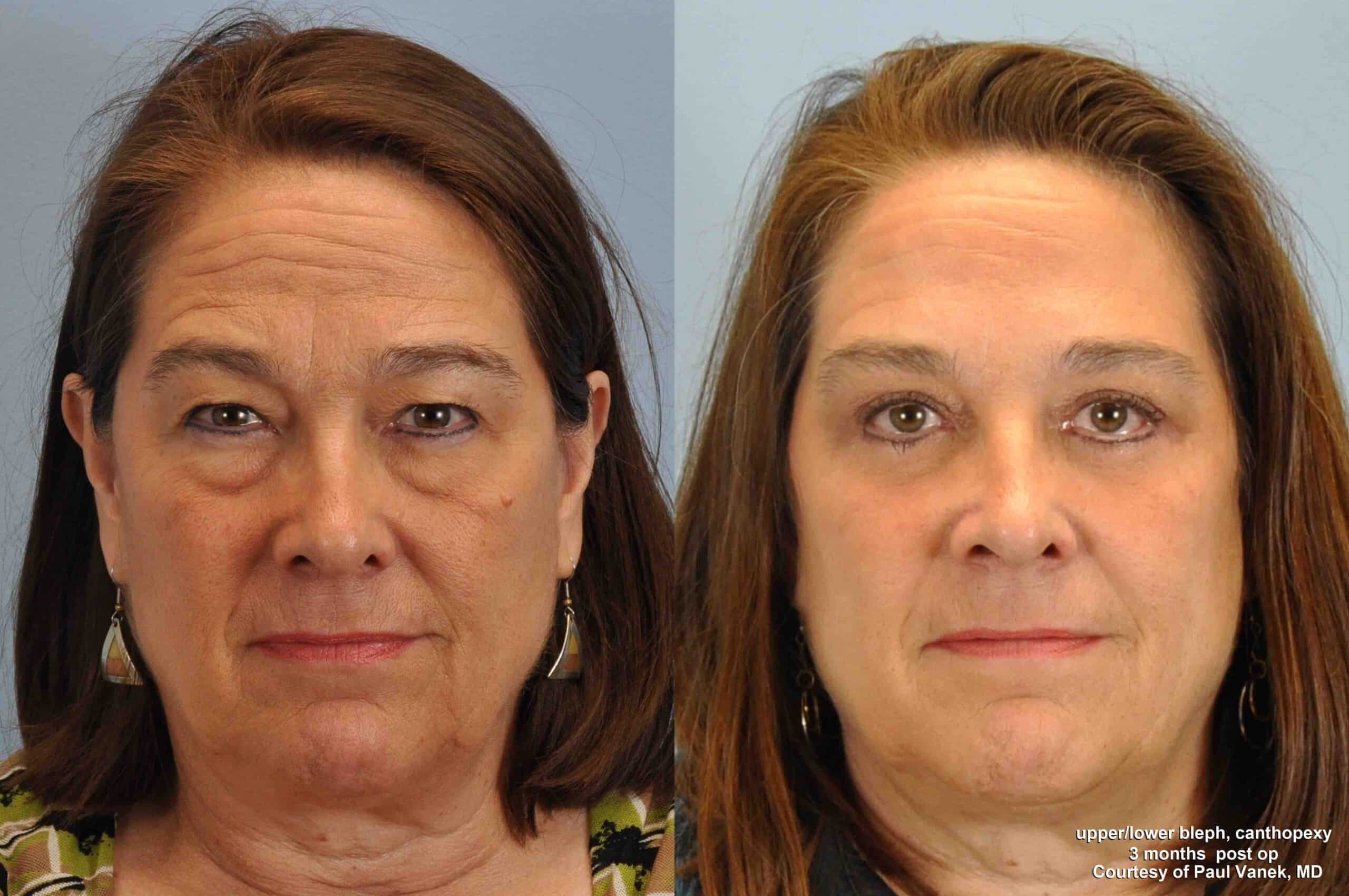 Before and after, 2 mo post op from Upper and Lower Blepharoplasty, Canthoplexy performed by Dr. Paul Vanek (front view)