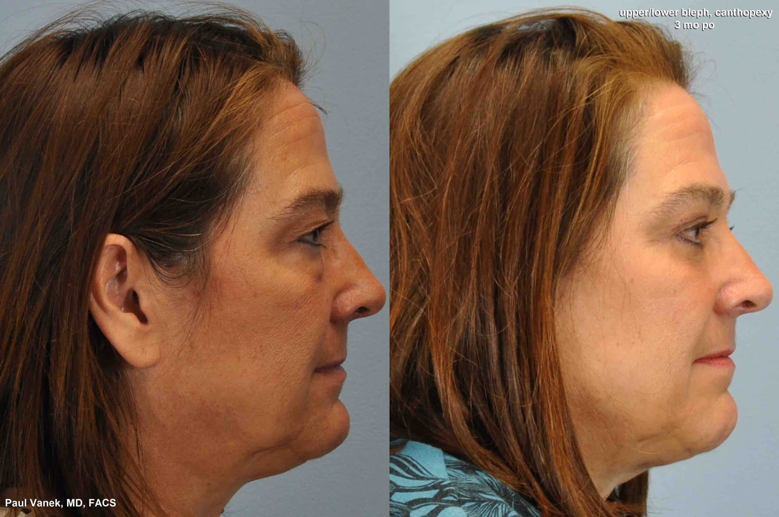 Before and after, 2 mo post op from Upper and Lower Blepharoplasty, Canthoplexy performed by Dr. Paul Vanek (side view)