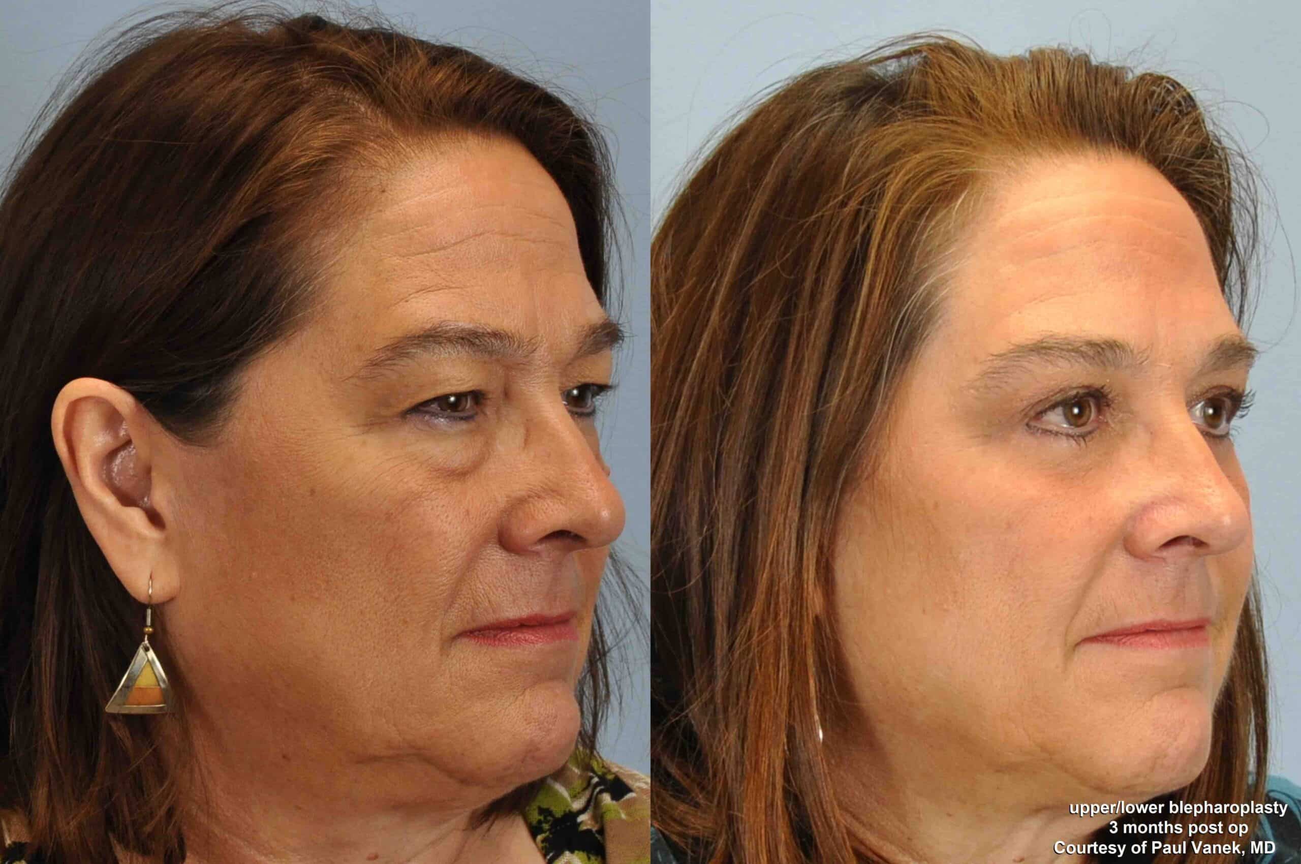 Before and after, 2 mo post op from Upper and Lower Blepharoplasty, Canthoplexy performed by Dr. Paul Vanek (diagonal view)