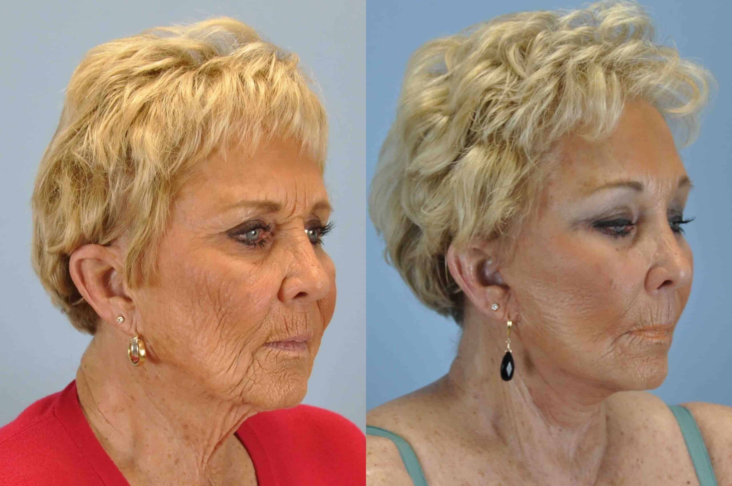 Before and after, 1 mo post op from Upper and Lower Blepharoplasty, Facelift, Neck Lift, Endo Brow Lift performed by Dr. Paul Vanek (diagonal view)