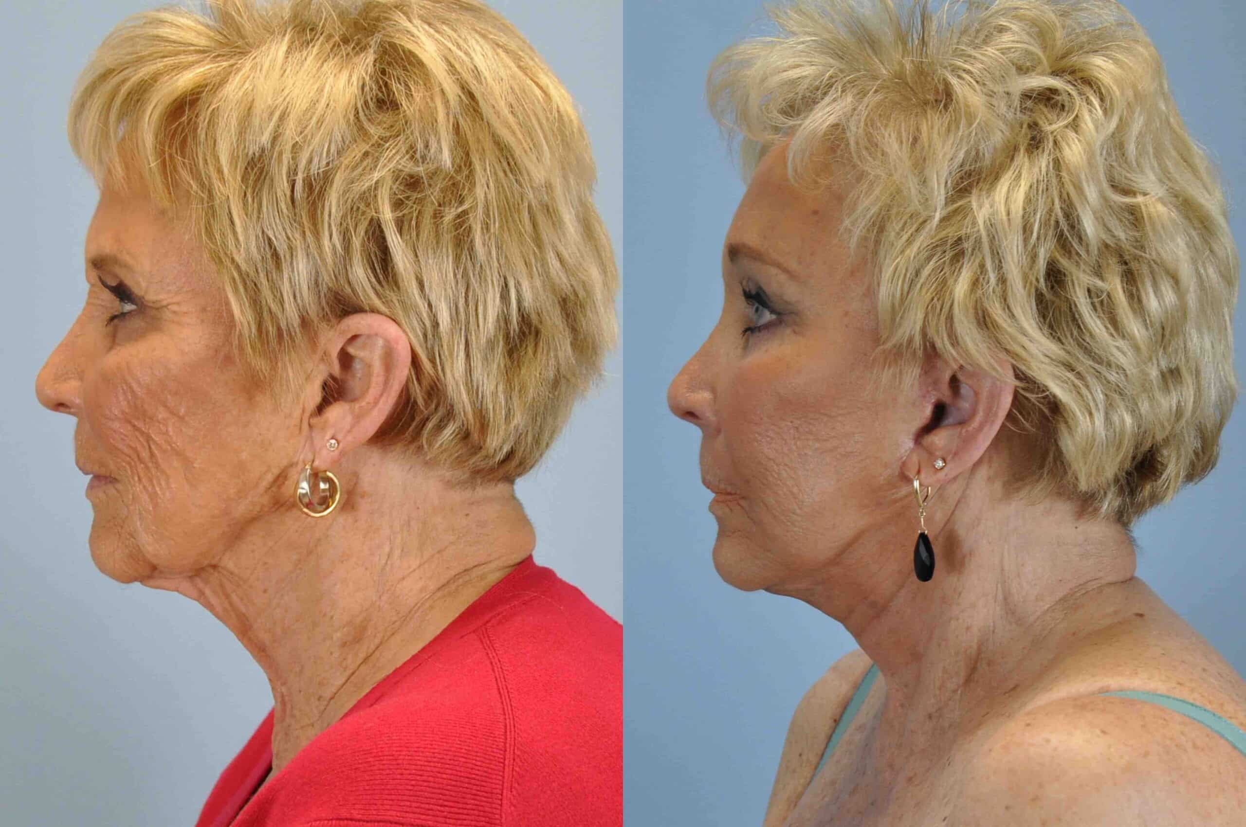 Before and after, 1 mo post op from Upper and Lower Blepharoplasty, Facelift, Neck Lift, Endo Brow Lift performed by Dr. Paul Vanek (side view)