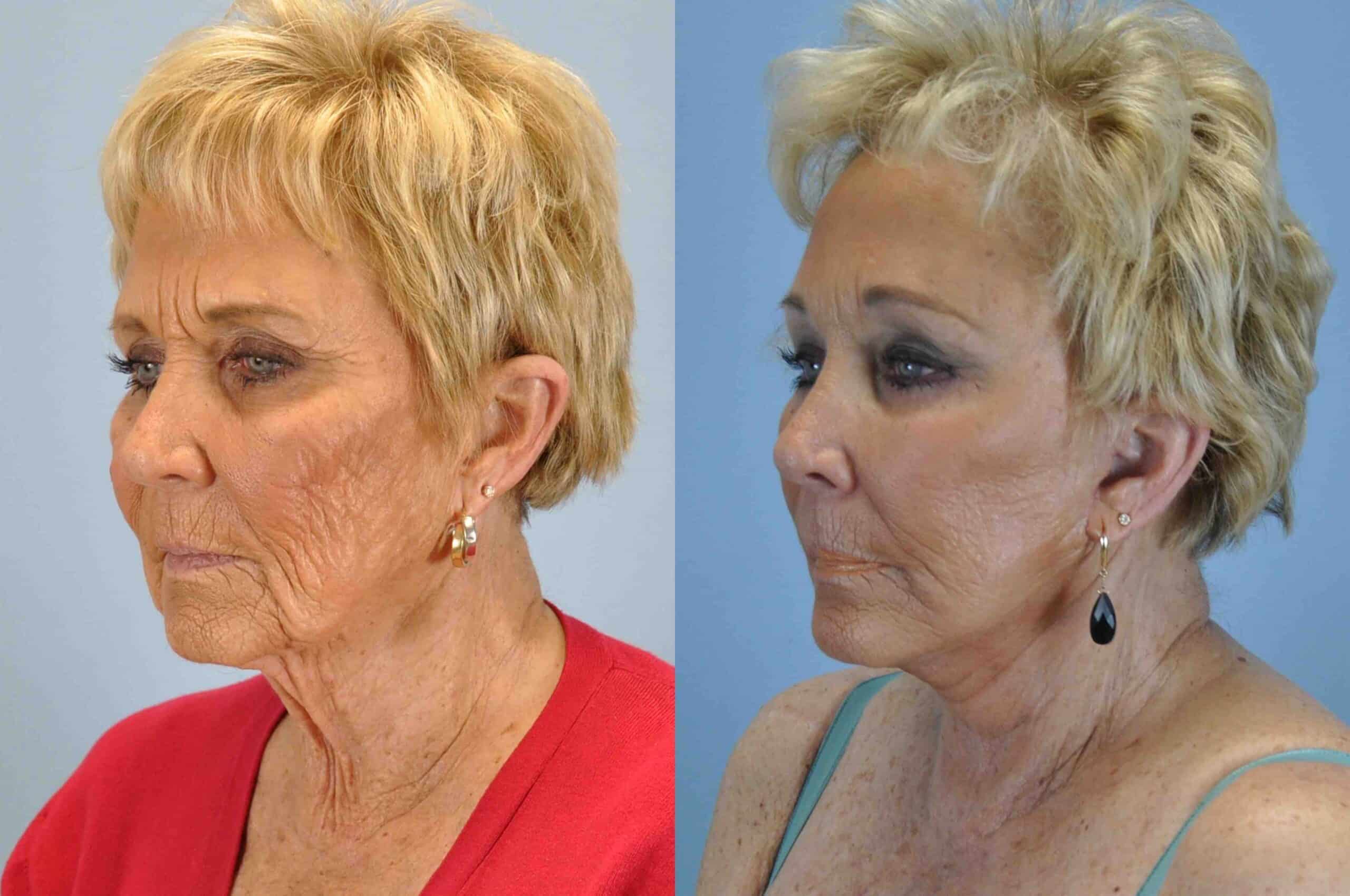 Before and after, 1 mo post op from Upper and Lower Blepharoplasty, Facelift, Neck Lift, Endo Brow Lift performed by Dr. Paul Vanek (diagonal view)