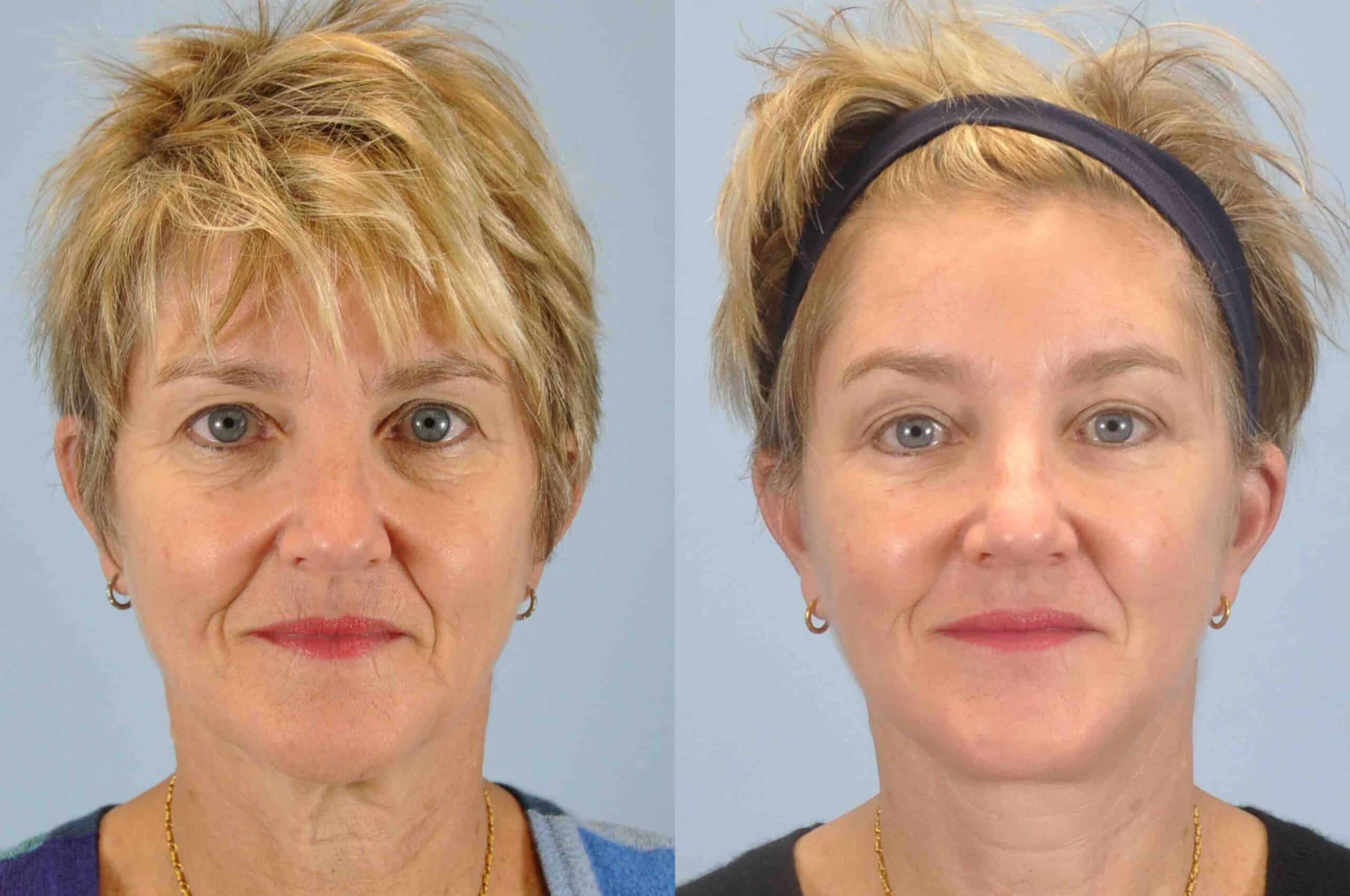 Before and after, patient 3 mo post op form Upper and Lower Blepharoplasty, Autologous Fat Transfer to Face, Facelift, Neck Lift performed by Dr. Paul Vanek