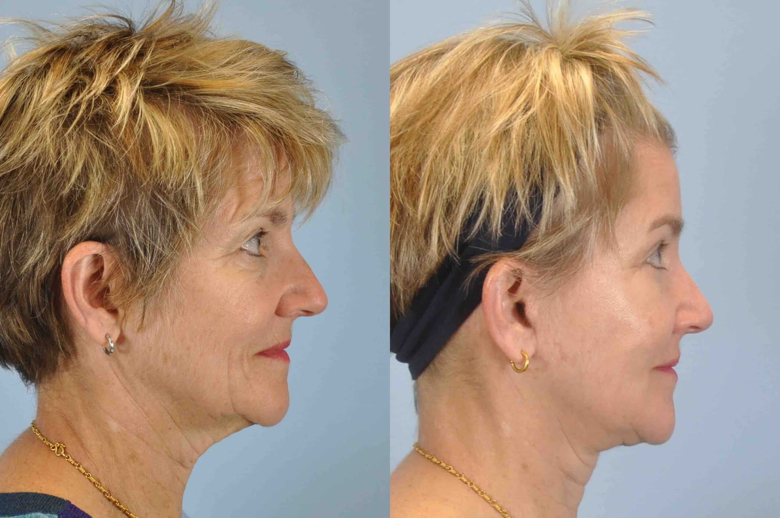 Before and after, patient 3 mo post op form Upper and Lower Blepharoplasty, Autologous Fat Transfer to Face, Facelift, Neck Lift performed by Dr. Paul Vanek