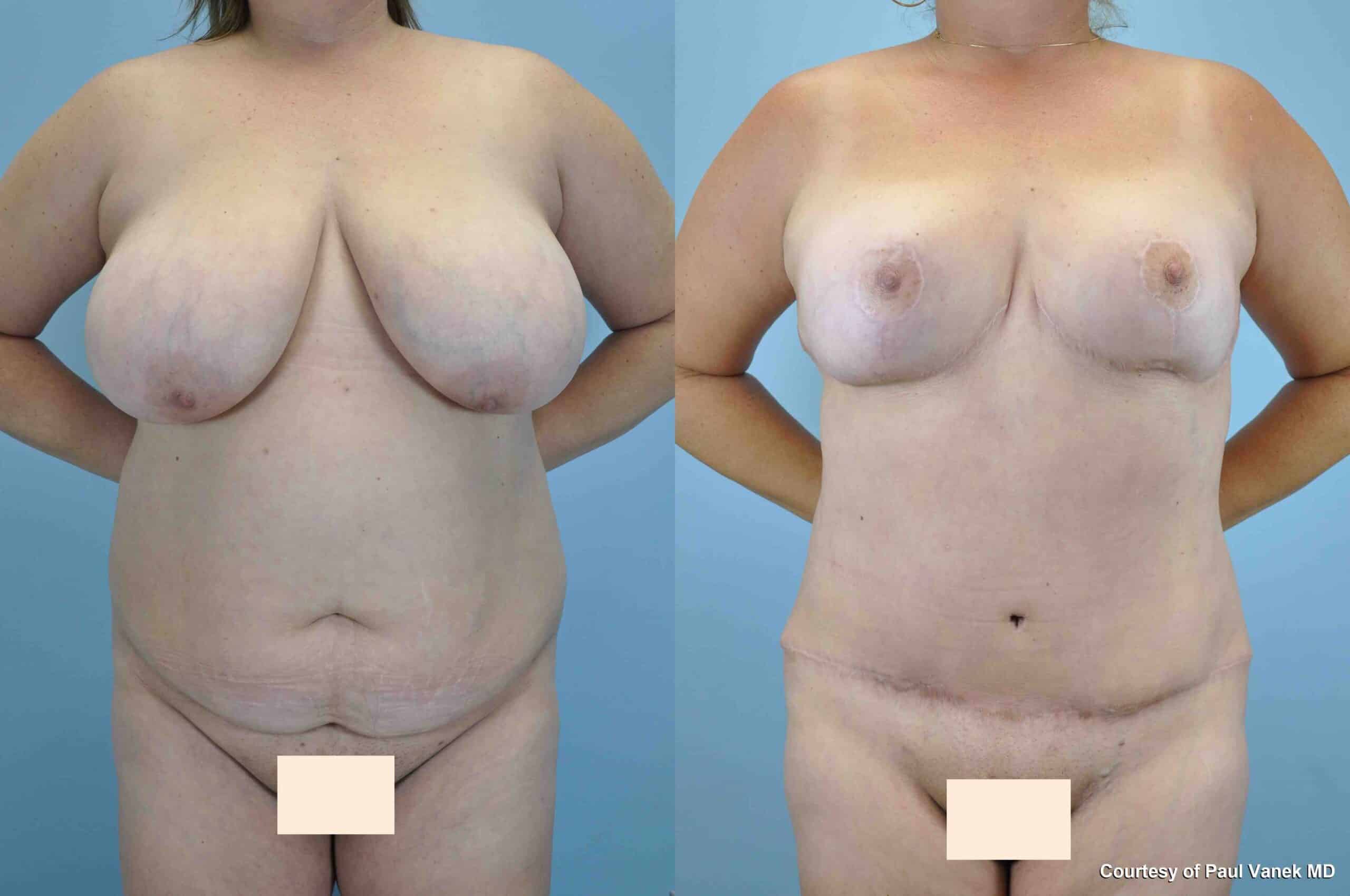 Before and after, patient 7 mo post op from Breast Reduction, Tummy Tuck, VASER Abdomen, Axilla Flanks, Back, Brazilian Butt Lift procedures performed by Dr. Paul Vanek