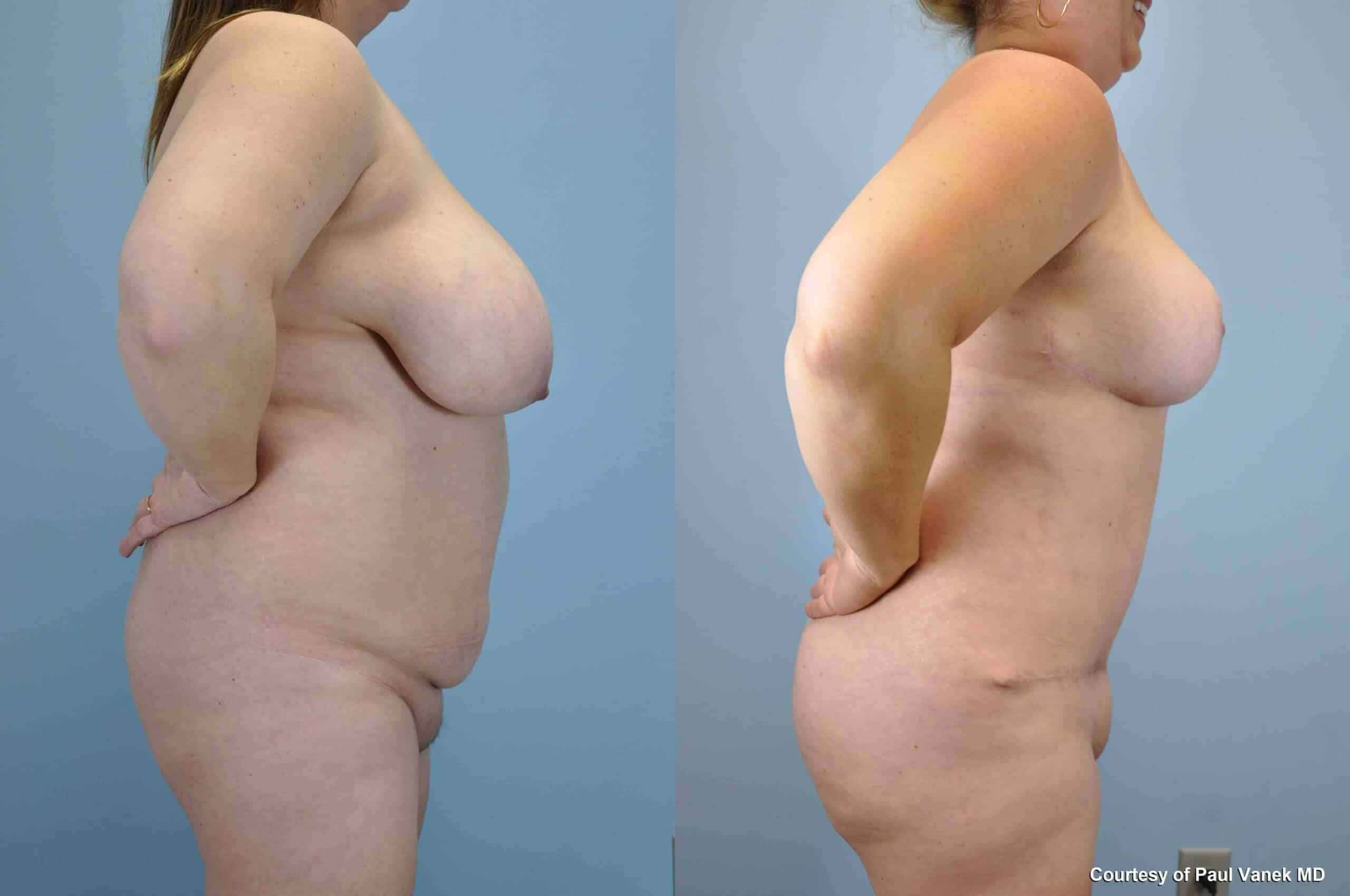 Before and after, patient 7 mo post op from Breast Reduction, Tummy Tuck, VASER Abdomen, Axilla Flanks, Back, Brazilian Butt Lift procedures performed by Dr. Paul Vanek