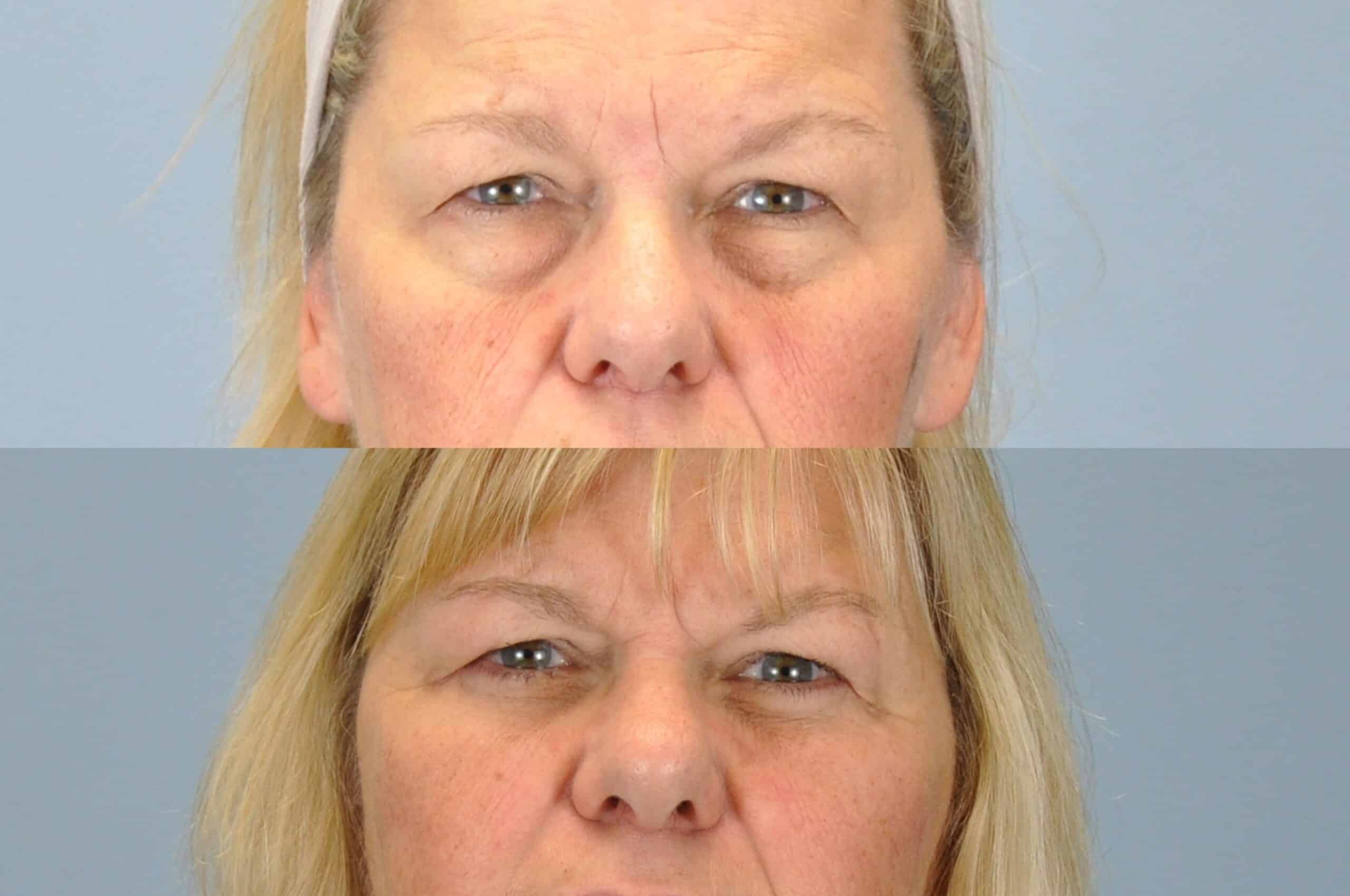 Before and after, 7 mo post op from Endo Brow Lift, Lower Blepharoplasty, Canthopexy performed by Dr. Paul Vanek (front view)