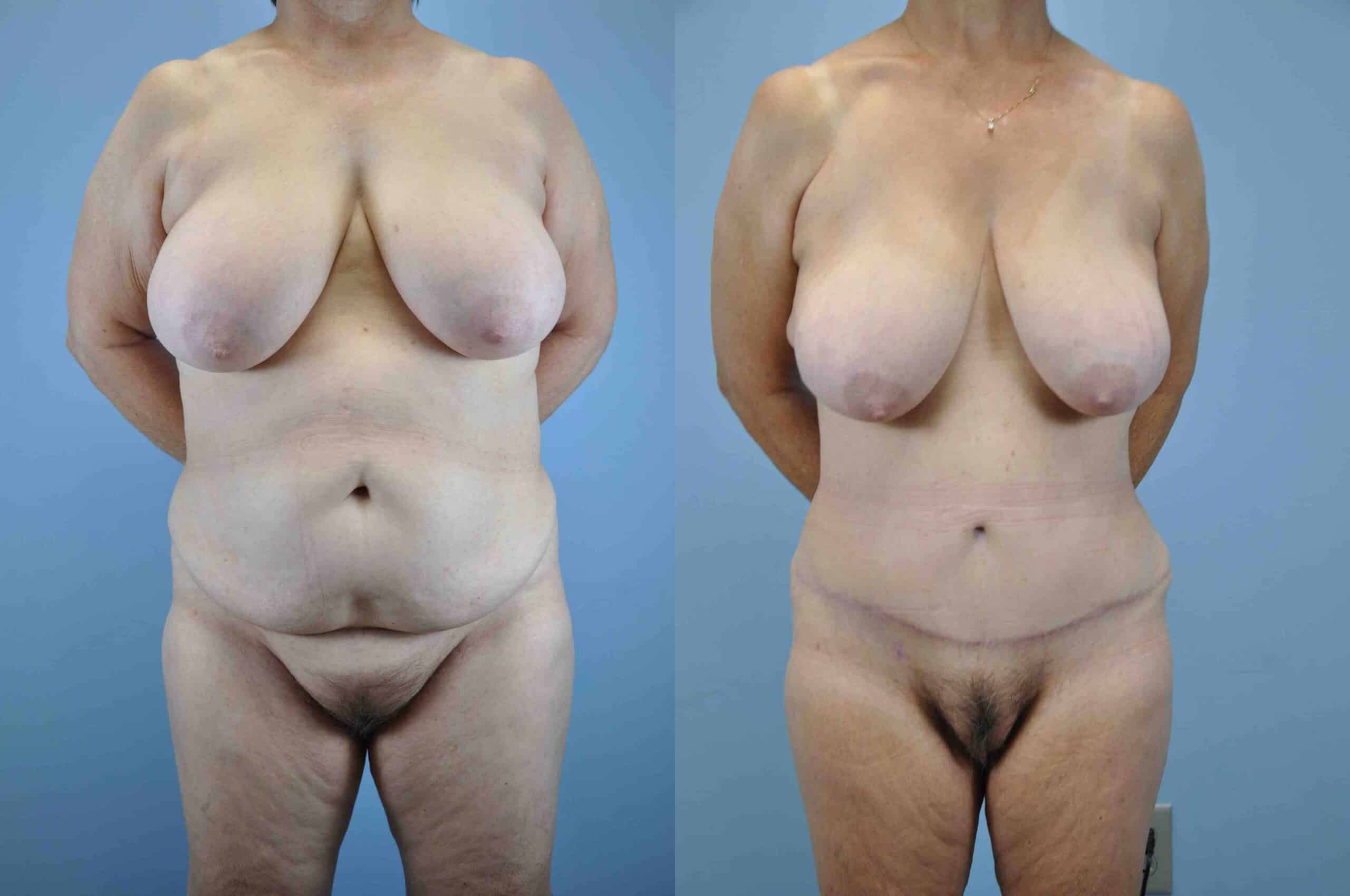 Before and after, patient 6 mo post op from VASER Abdomen, Flanks, Mons, Tummy Tuck procedures performed by Dr. Paul Vanek