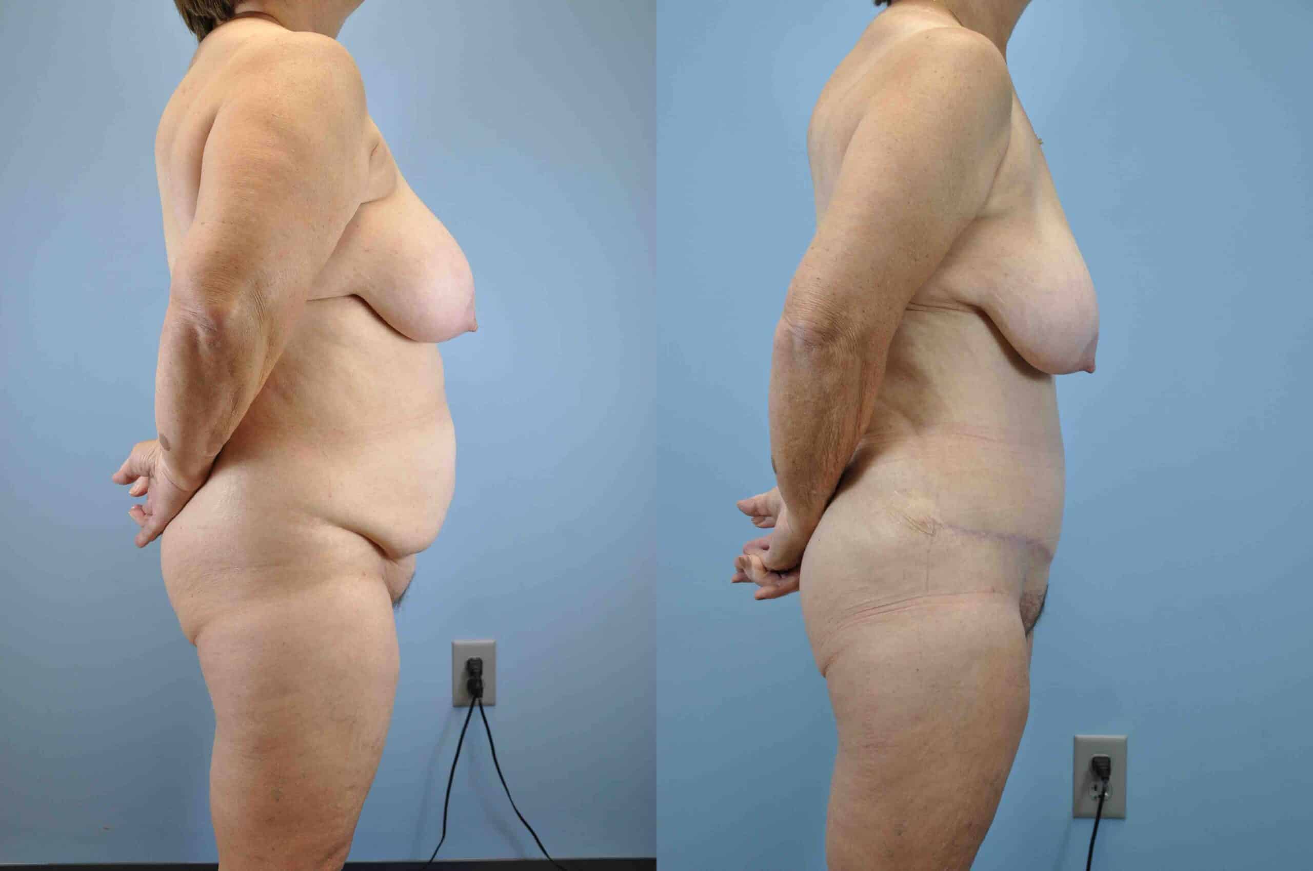 Before and after, patient 6 mo post op from VASER Abdomen, Flanks, Mons, Tummy Tuck procedures performed by Dr. Paul Vanek