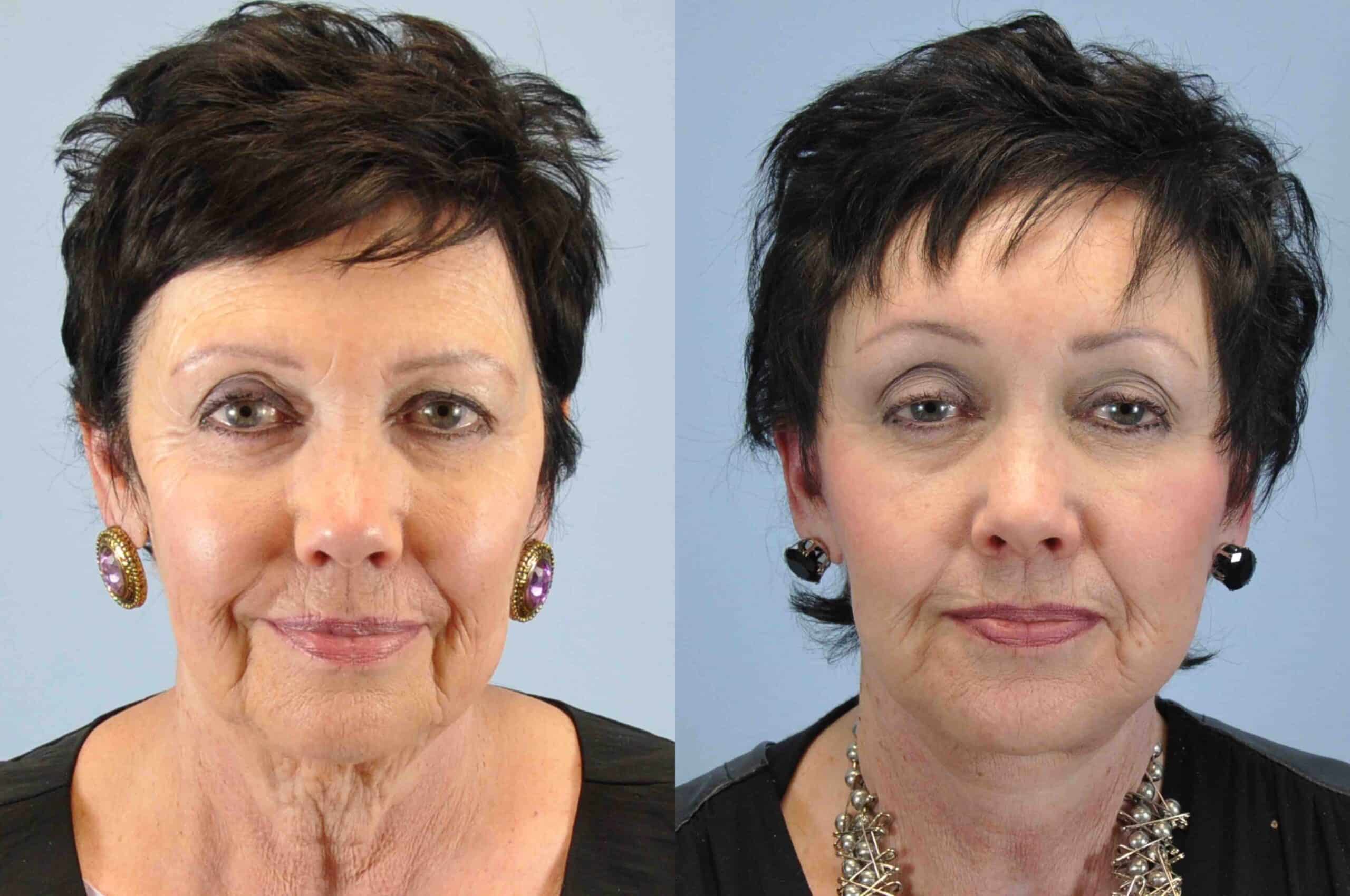 Before and after, patient 2 mo post op from Facelift, Neck Lift, Endobrow procedures performed by Dr. Paul Vanek