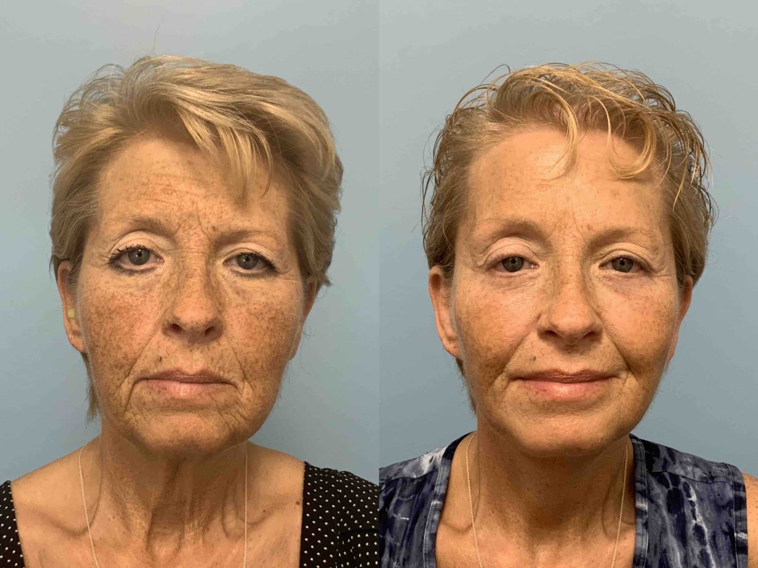 Before and after, patient 3 mo post op from Facelift, Neck Lift, Lower Blepharoplasty, Autologous fat Transfer Face procedures performed by Dr. Paul Vanek