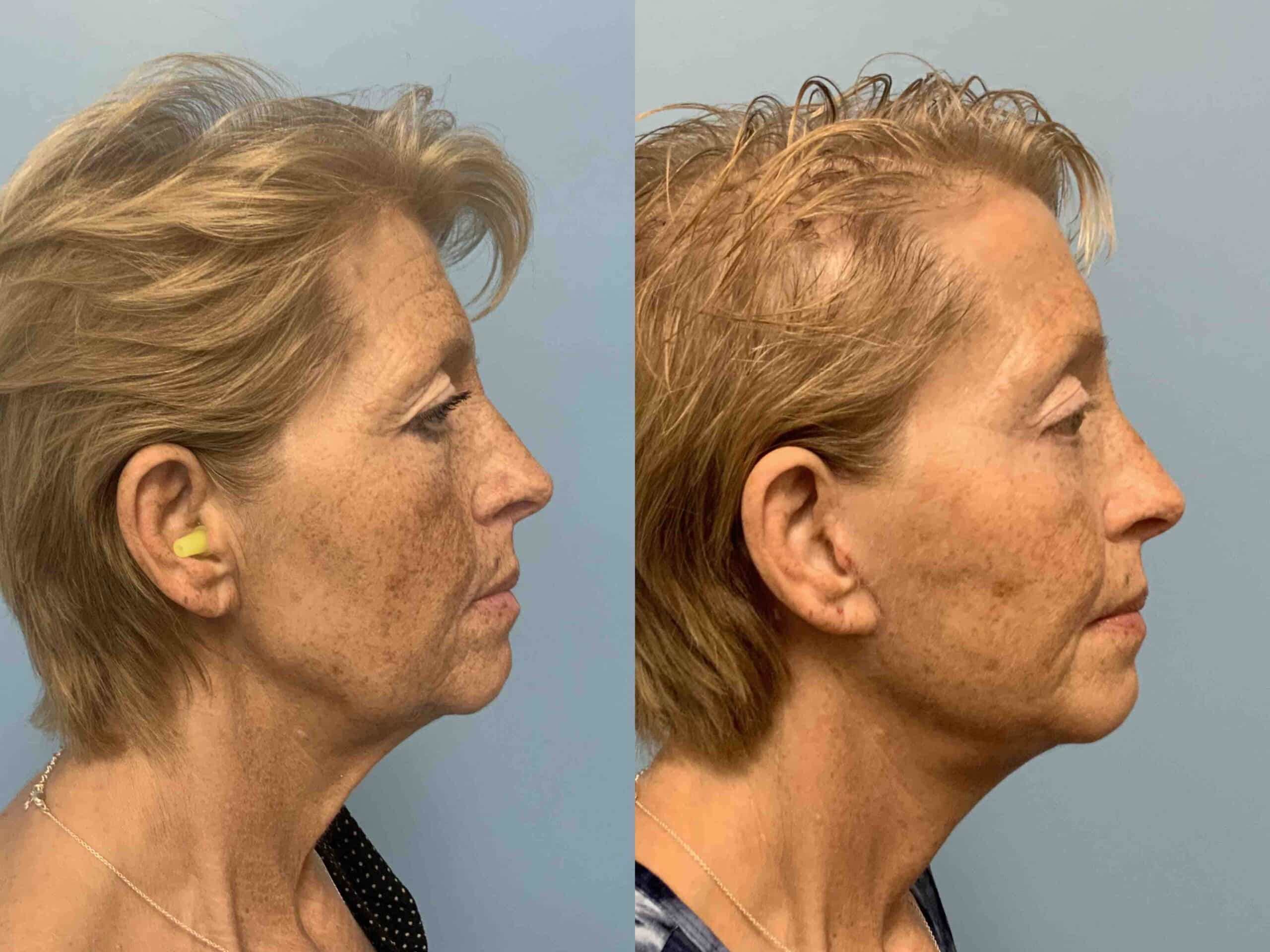 Before and after, patient 3 mo post op from Facelift, Neck Lift, Lower Blepharoplasty, Autologous fat Transfer Face procedures performed by Dr. Paul Vanek