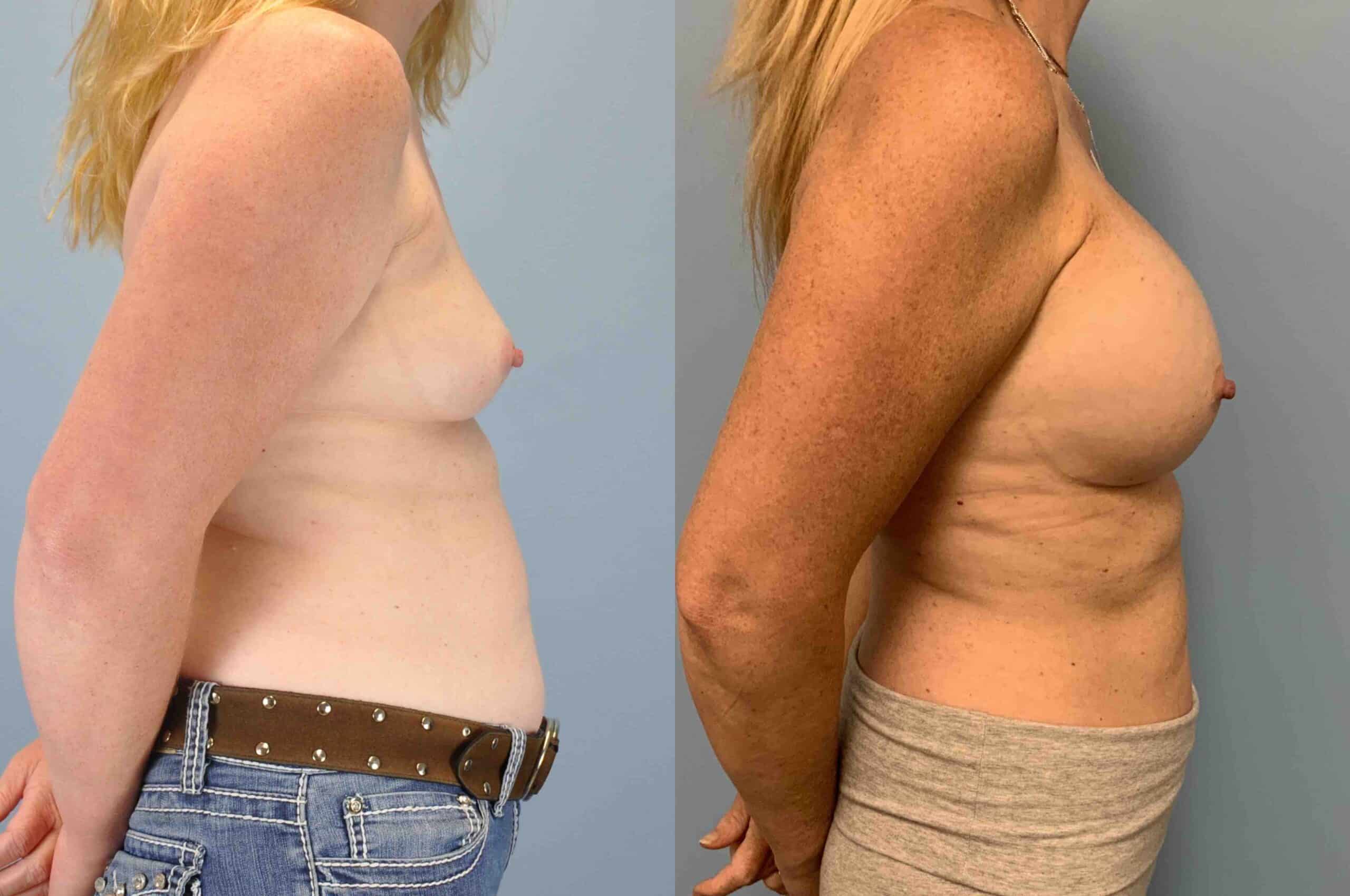 Before and after, patient 9 yr post op from Breast Augmentation procedure performed by Dr. Paul Vanek