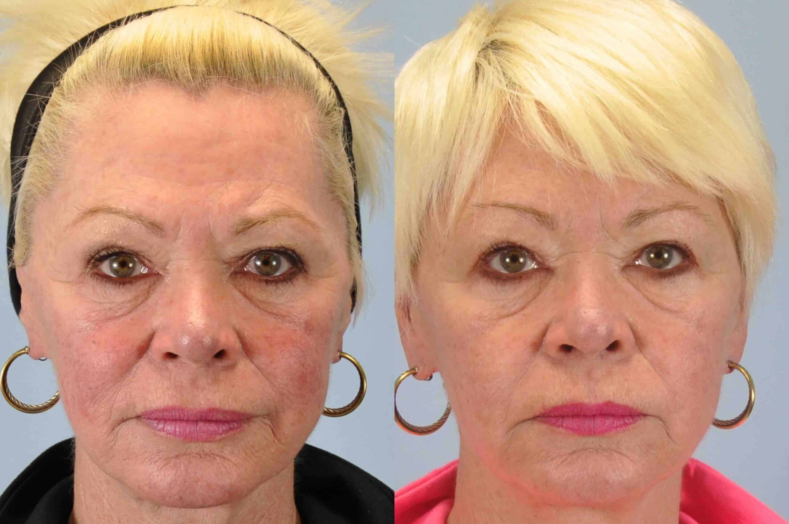 Before and after, 2 mo post-treatment from Laser Resurfacing performed by Dr. Paul Vanek