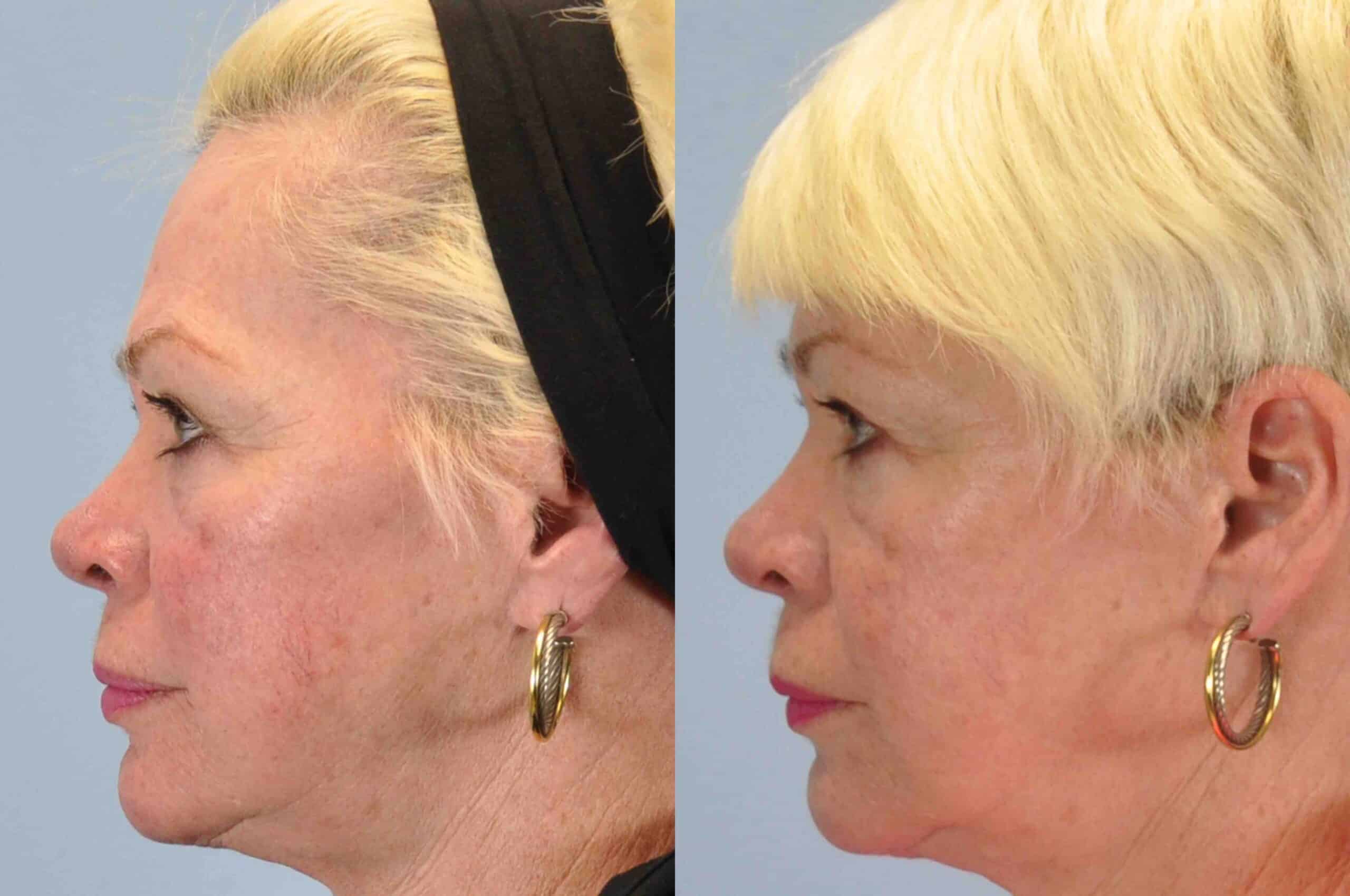 Before and after, 2 mo post-treatment from Laser Resurfacing performed by Dr. Paul Vanek
