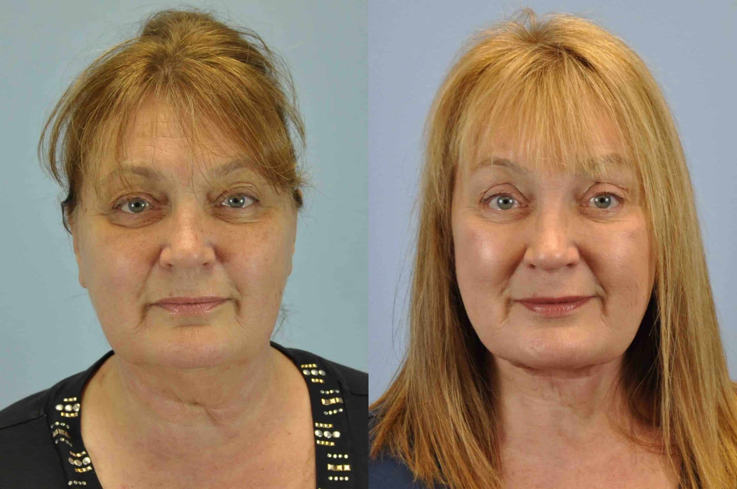 Before and after, Patient 3 yr post op from Facelift, Neck Lift, Upper and Lower Blepharoplasty, Canthopexy, Endo Browlift procedures performed by Dr. Paul Vanek