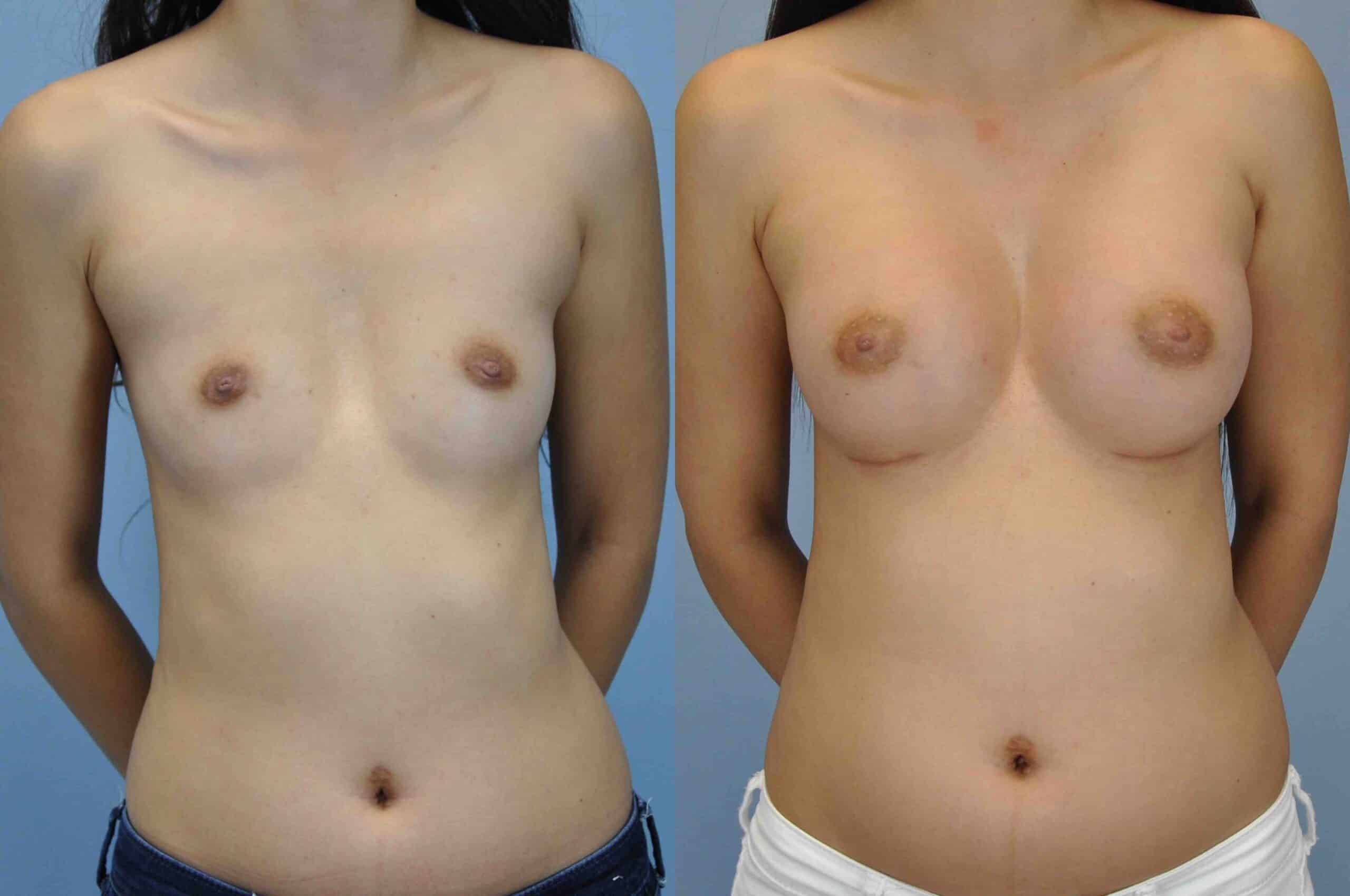 Before and after, patient 3 mo post op from Breast Augmentation and Level III Muscle Release procedures performed by Dr. Paul Vanek