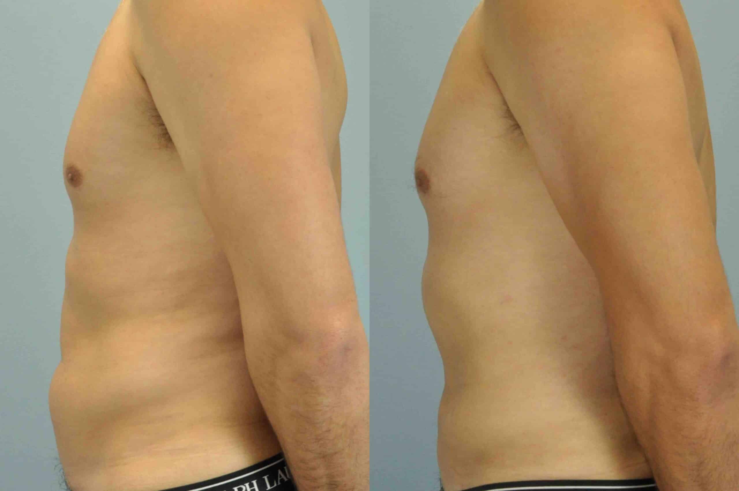 Before and after, patient 2 mo post op from VASER Abdomen and Flanks procedures performed by Dr. Paul Vanek