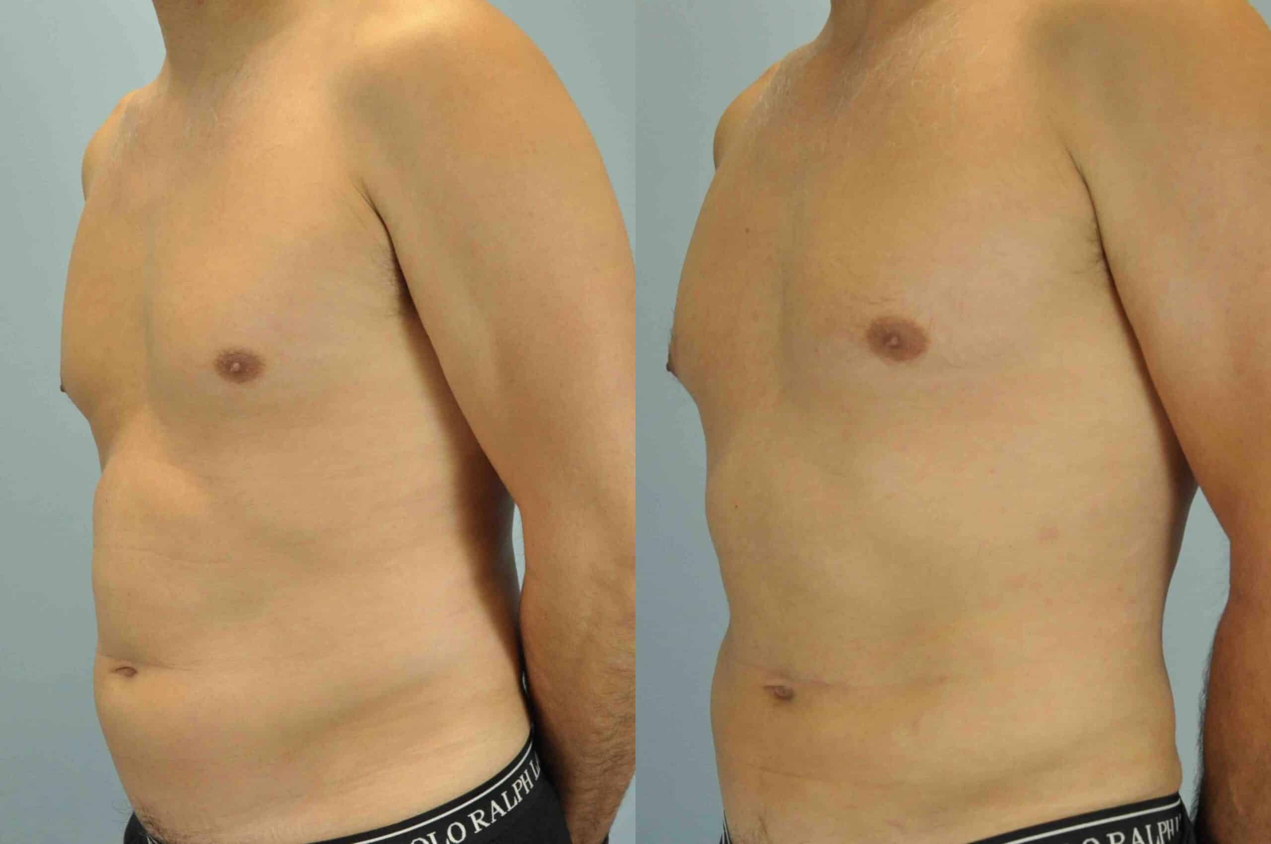 Before and after, patient 2 mo post op from VASER Abdomen and Flanks procedures performed by Dr. Paul Vanek