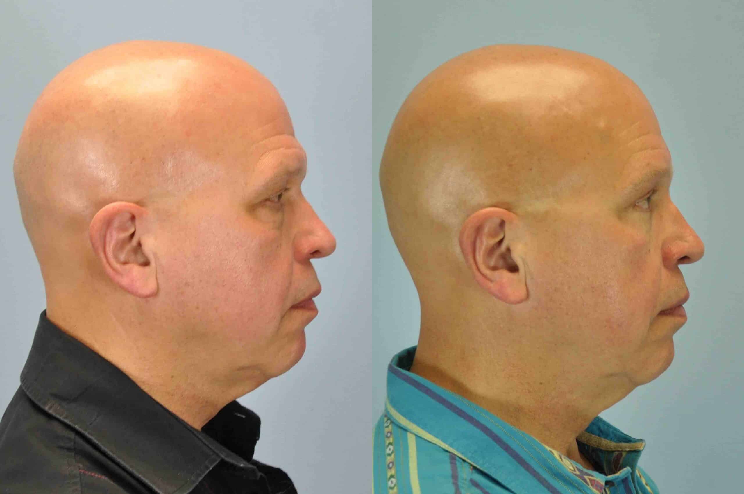 Before and after, patient 6 mo post op from Endo Brow procedure performed by Dr. Paul Vanek