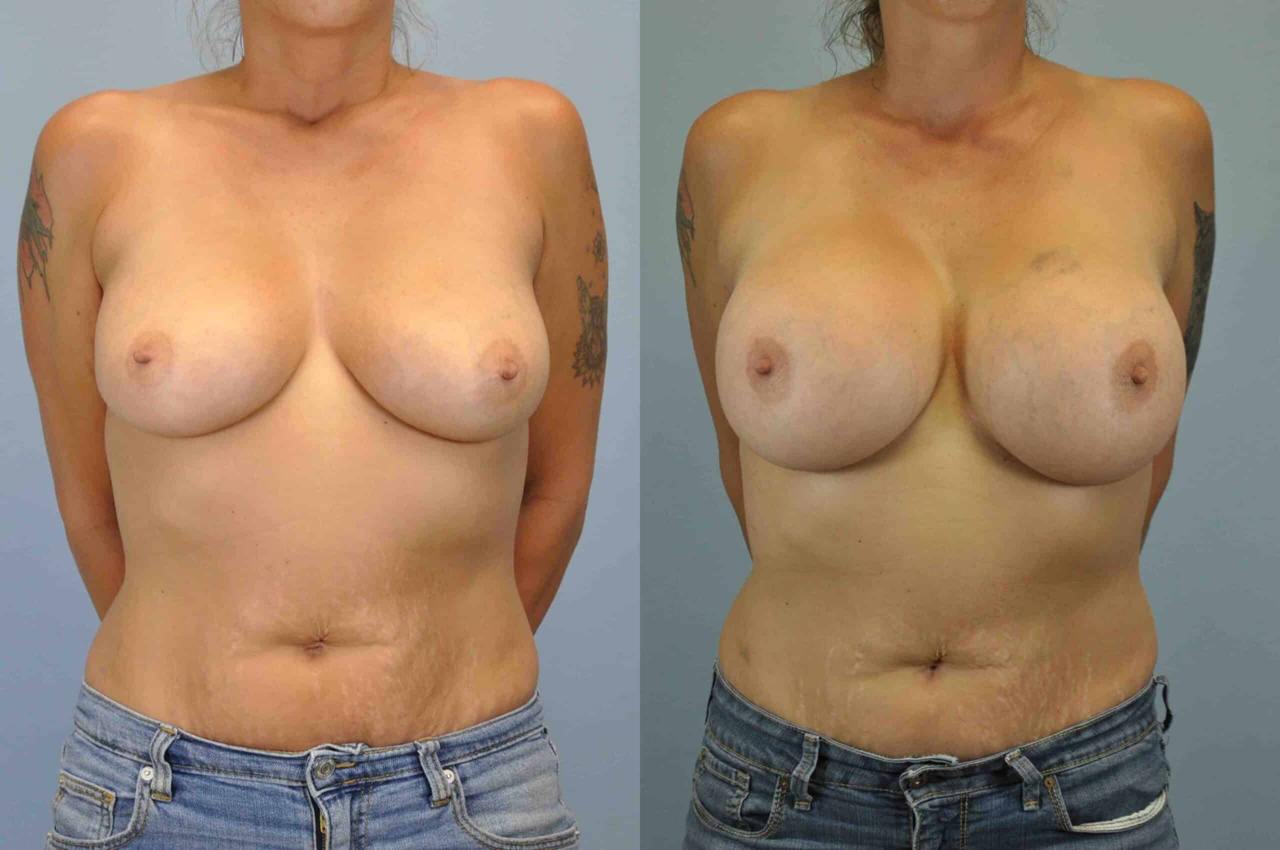 Before and after, patient 2 yr post op from breast augmentation and level III muscle release procedures performed by Dr. Paul Vanek